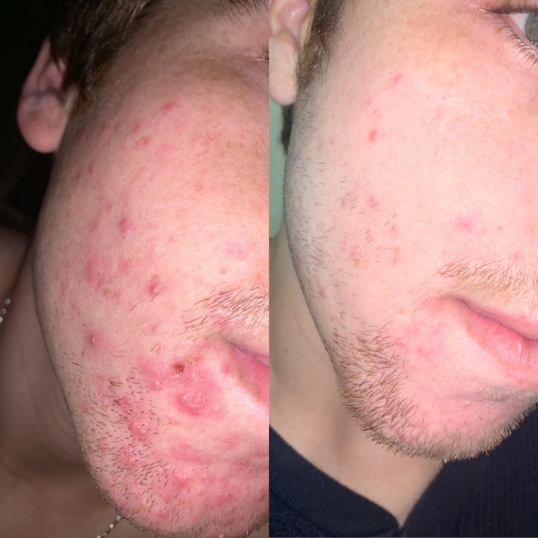 Dealt with some pretty bad cystic acne for about two years... wanted to
