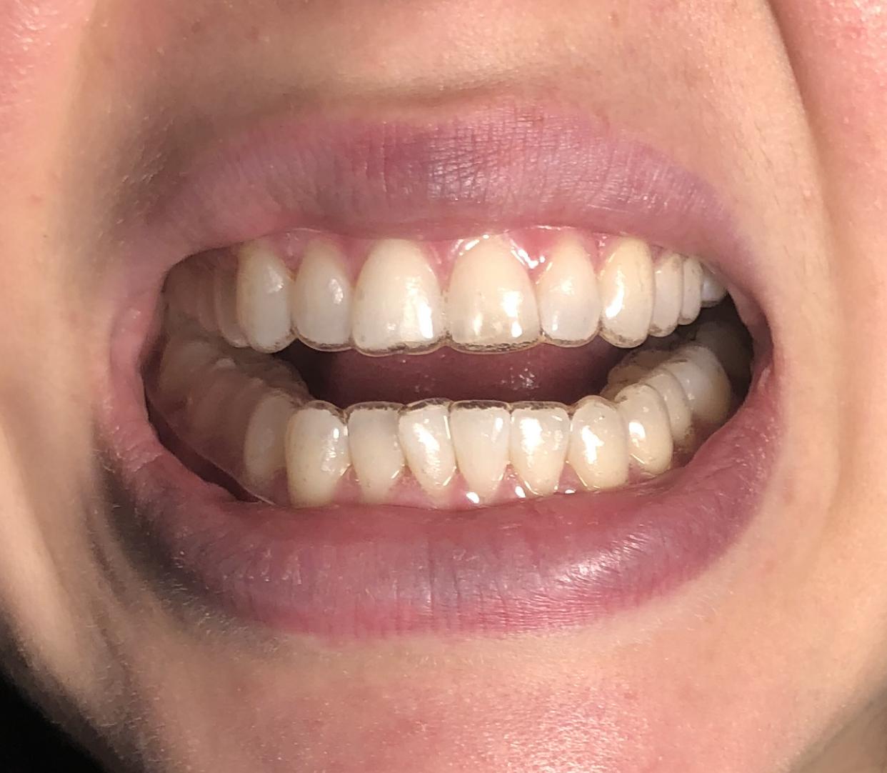 Just switched to M1 W3/4 trays today and have these spaces between my