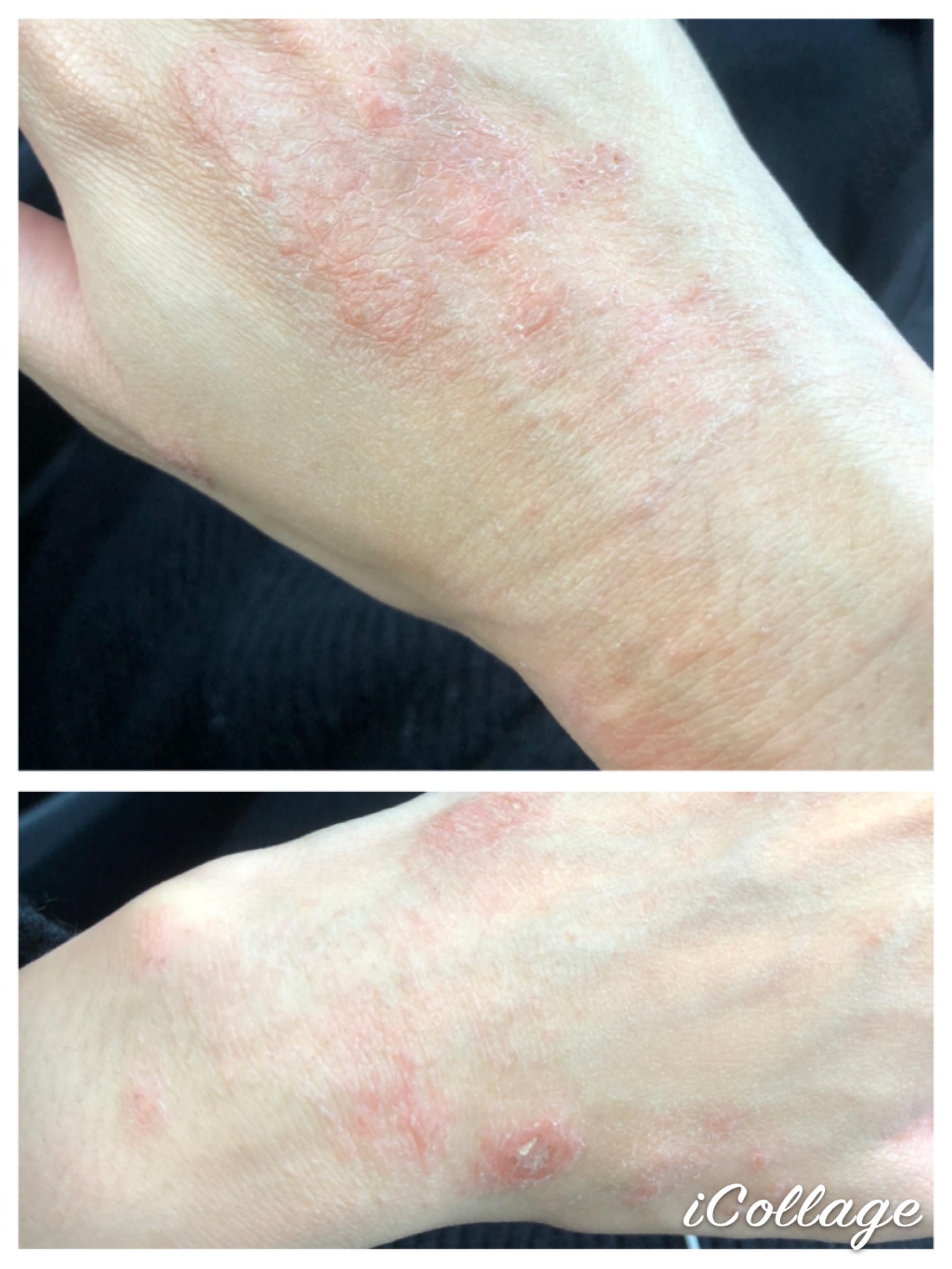 Eczema flaring up on hands like never before r/Accutane