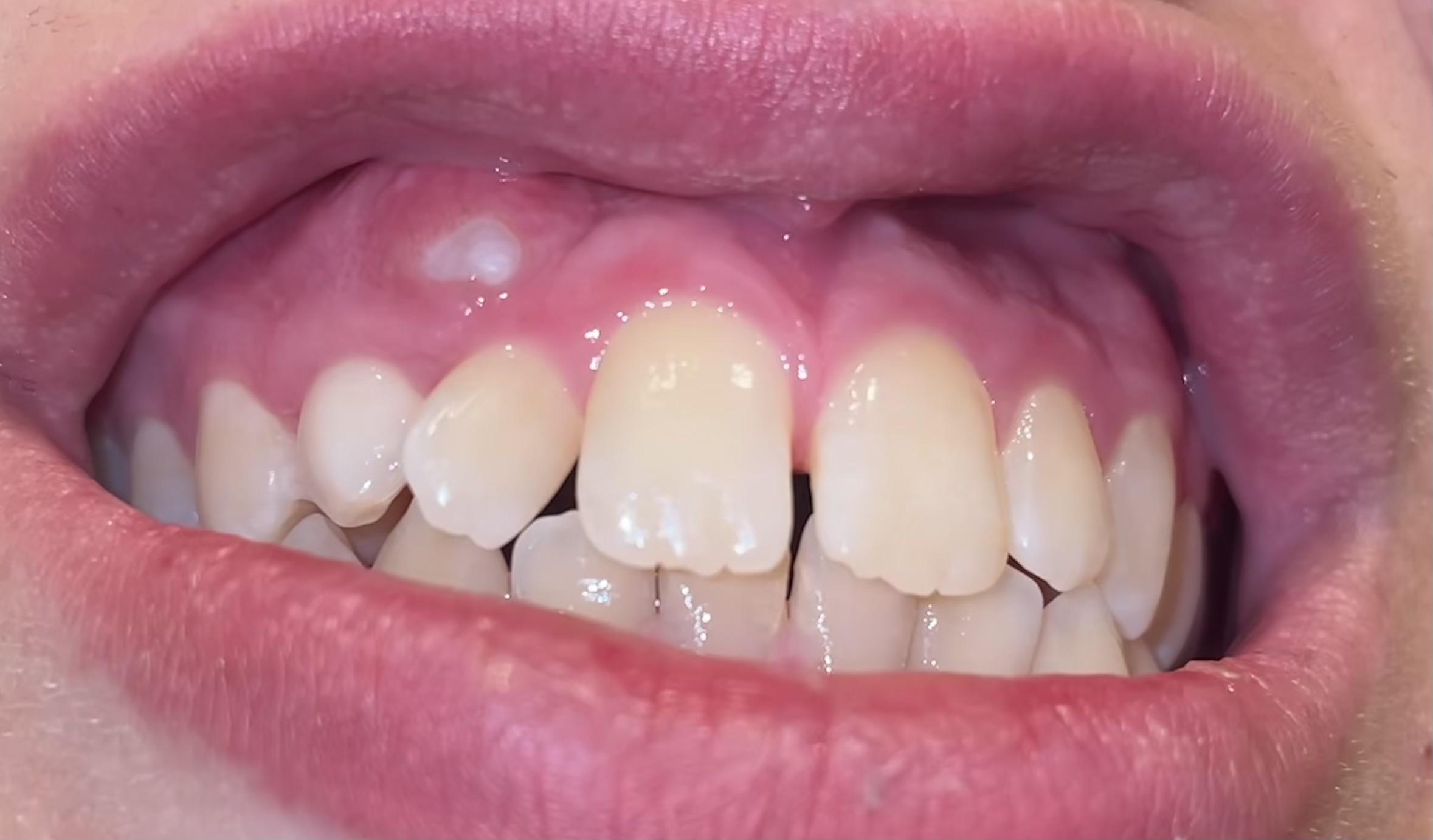 This swollen area appeared on my gums a few weeks ago and now there is