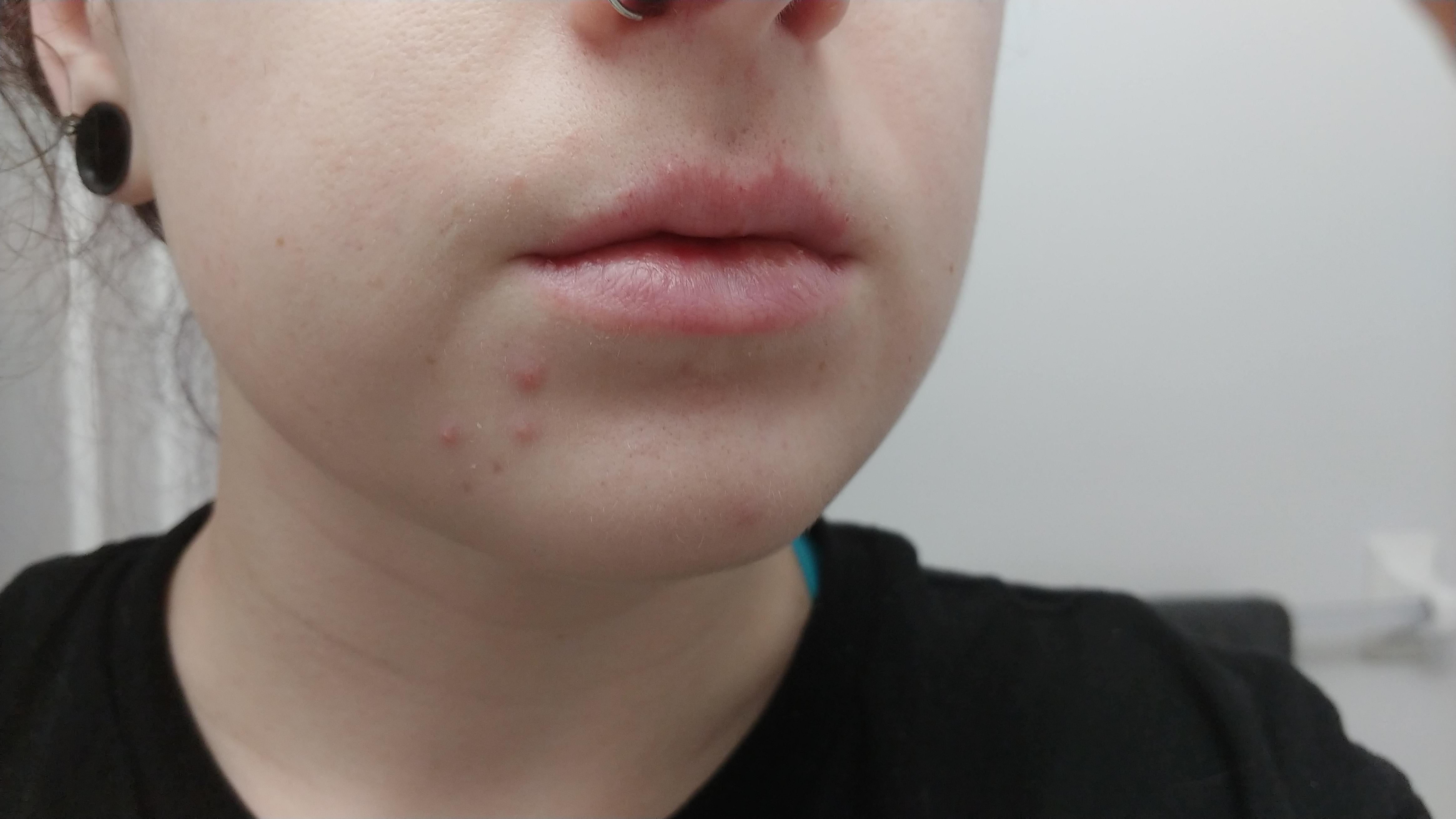 [skin concerns] [acne] Wearing a mask at work is causing my mouth and