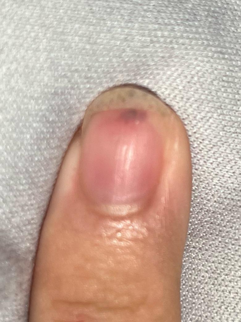 What is this black spot under fingernail? r/Whatisthis