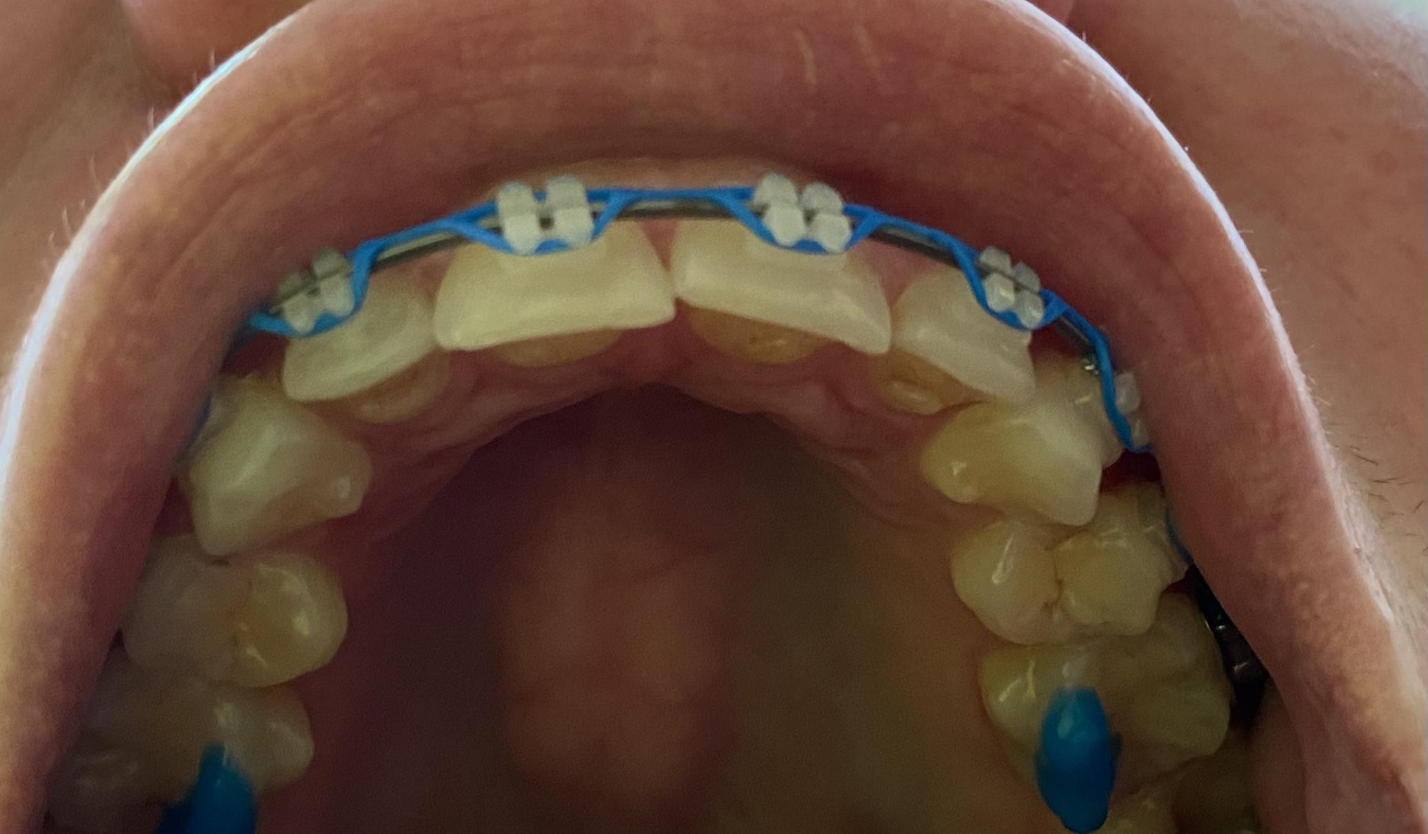 Two days ago these were perfectly straight. Then I had an adjustment