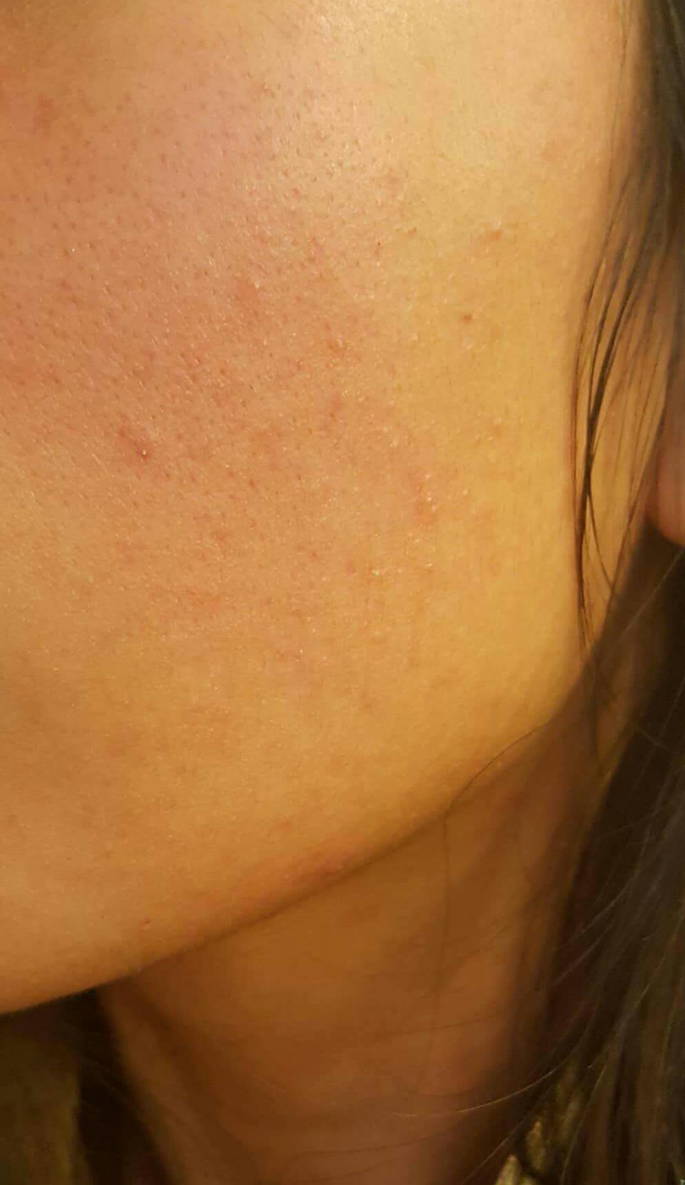 [Skin concerns] Dehydrated skin or white heads? r/SkincareAddiction
