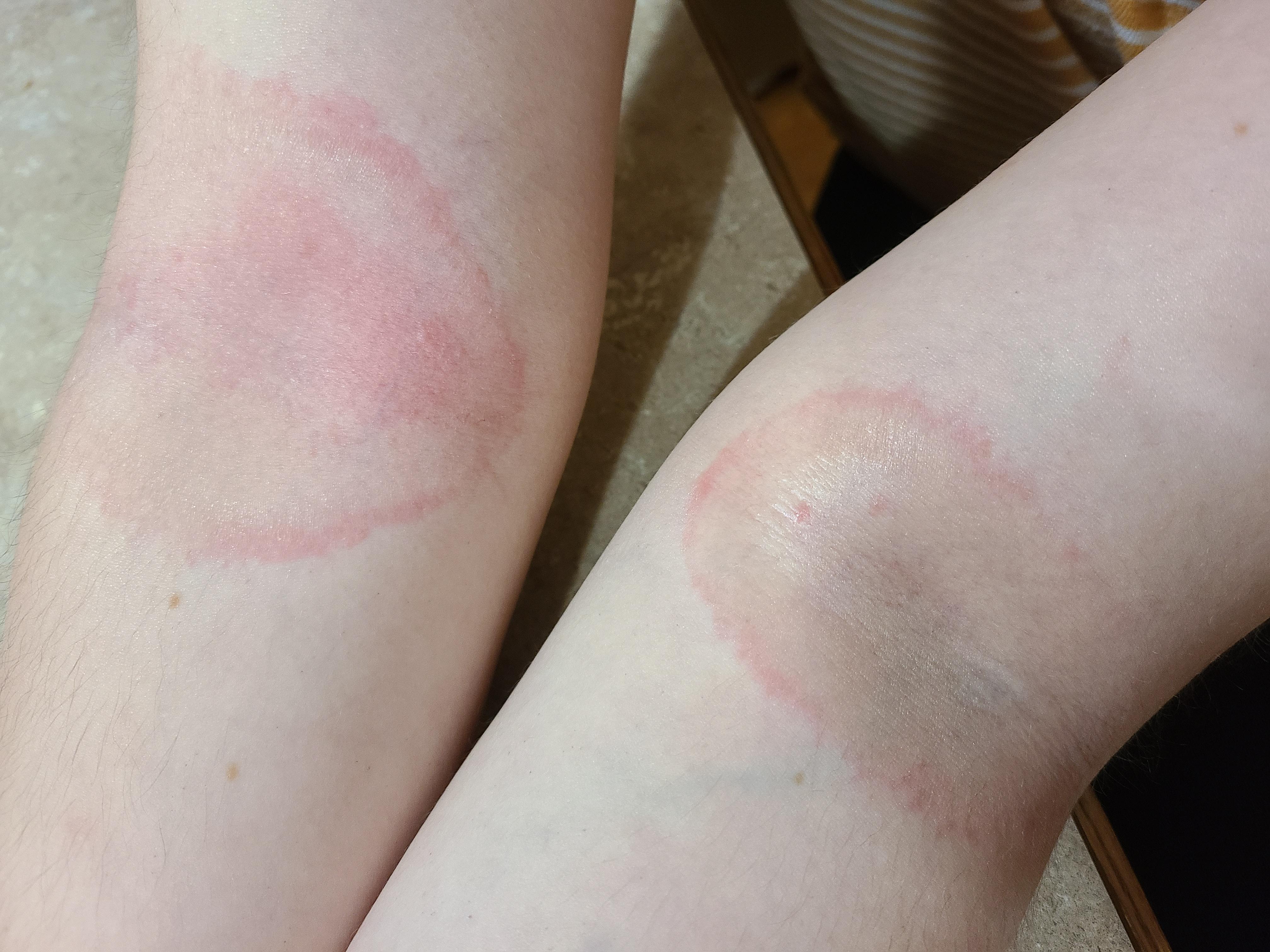 I have POTS and possibly MCAS. I know MCAS comes with rashes, but could