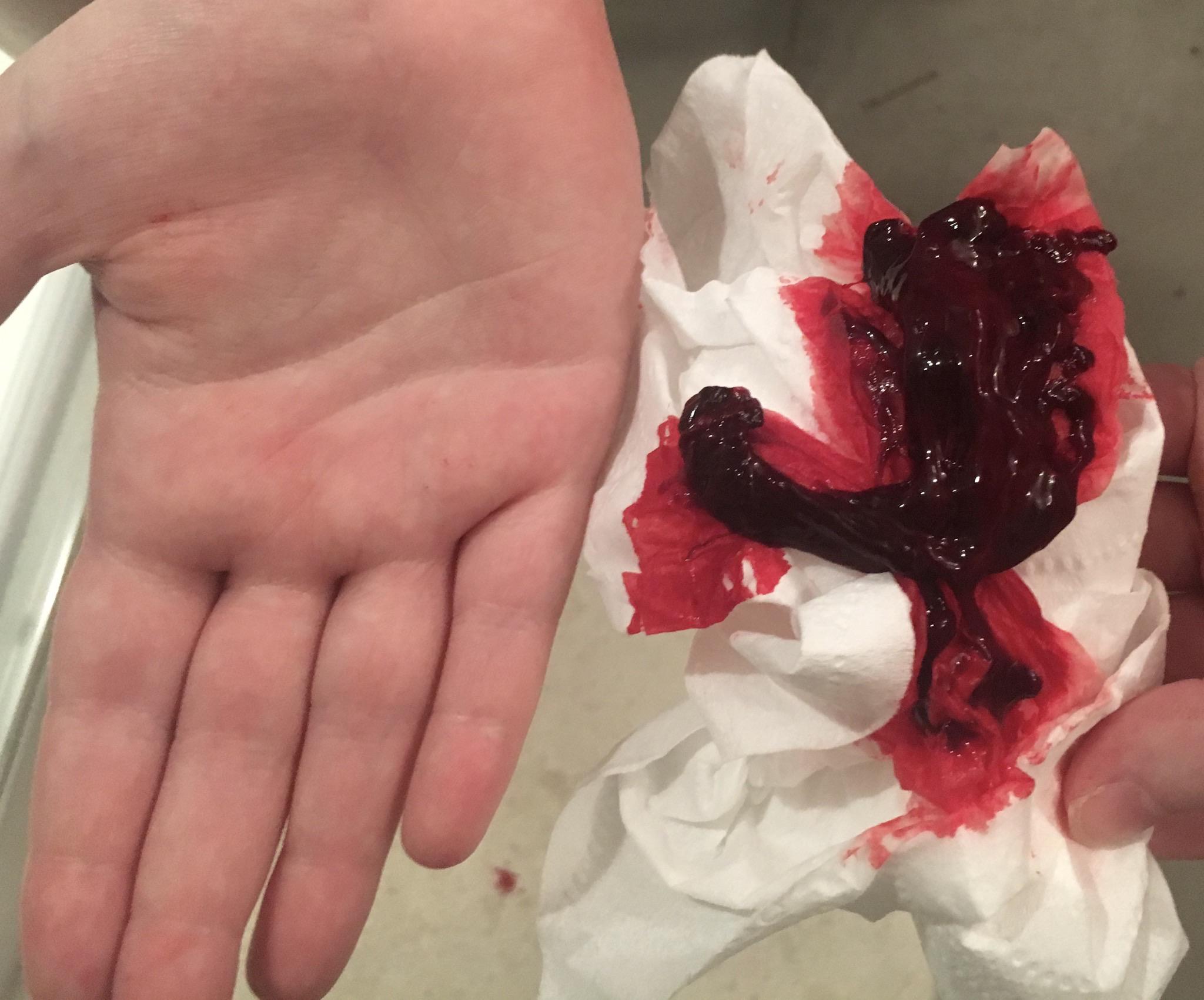 【印刷可能】 black blood clots period 384584Thick sticky blood clots period