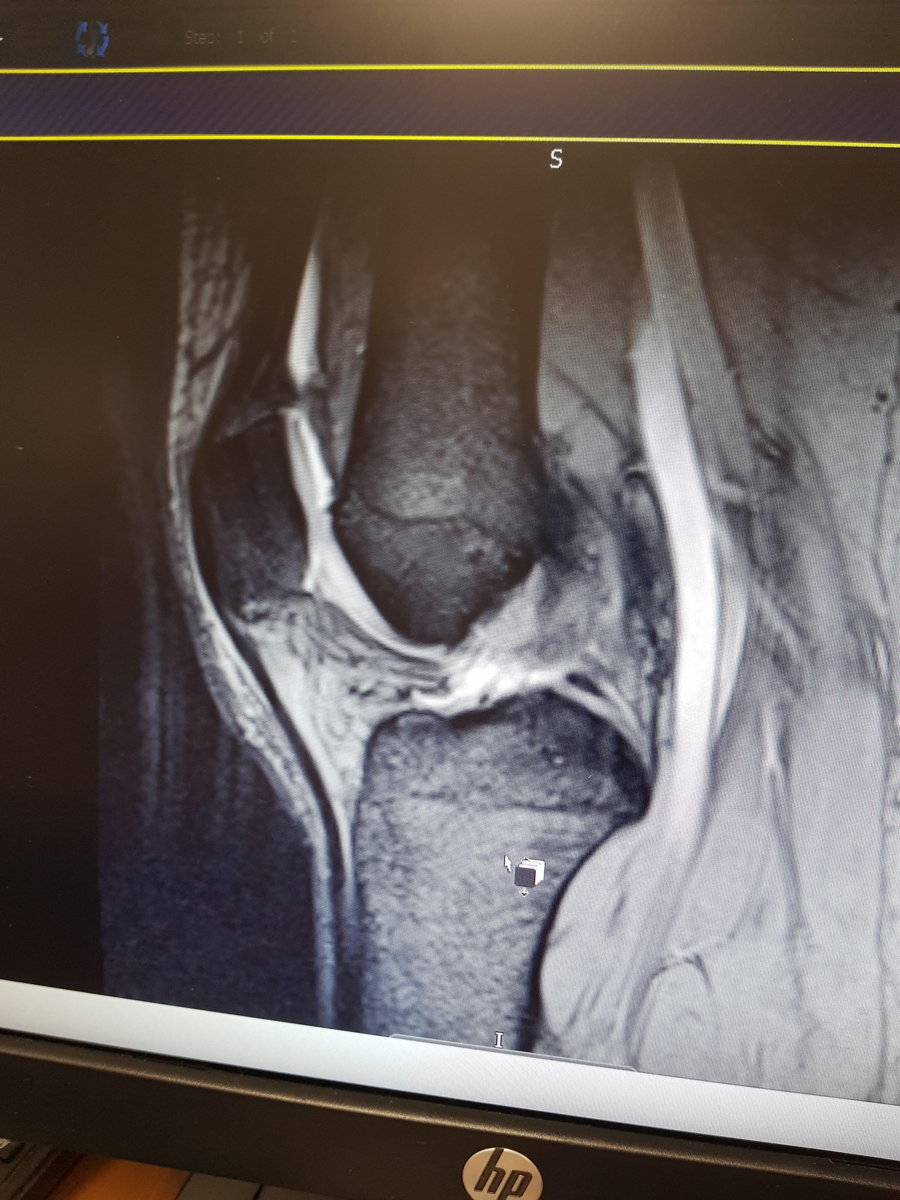 Suffering from knee pain, MRI not showing the source of acute pain, any