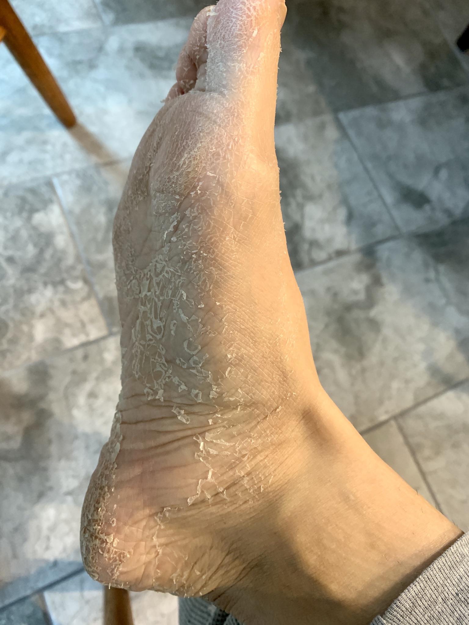 Tried foot peel socks, highly r/peeling