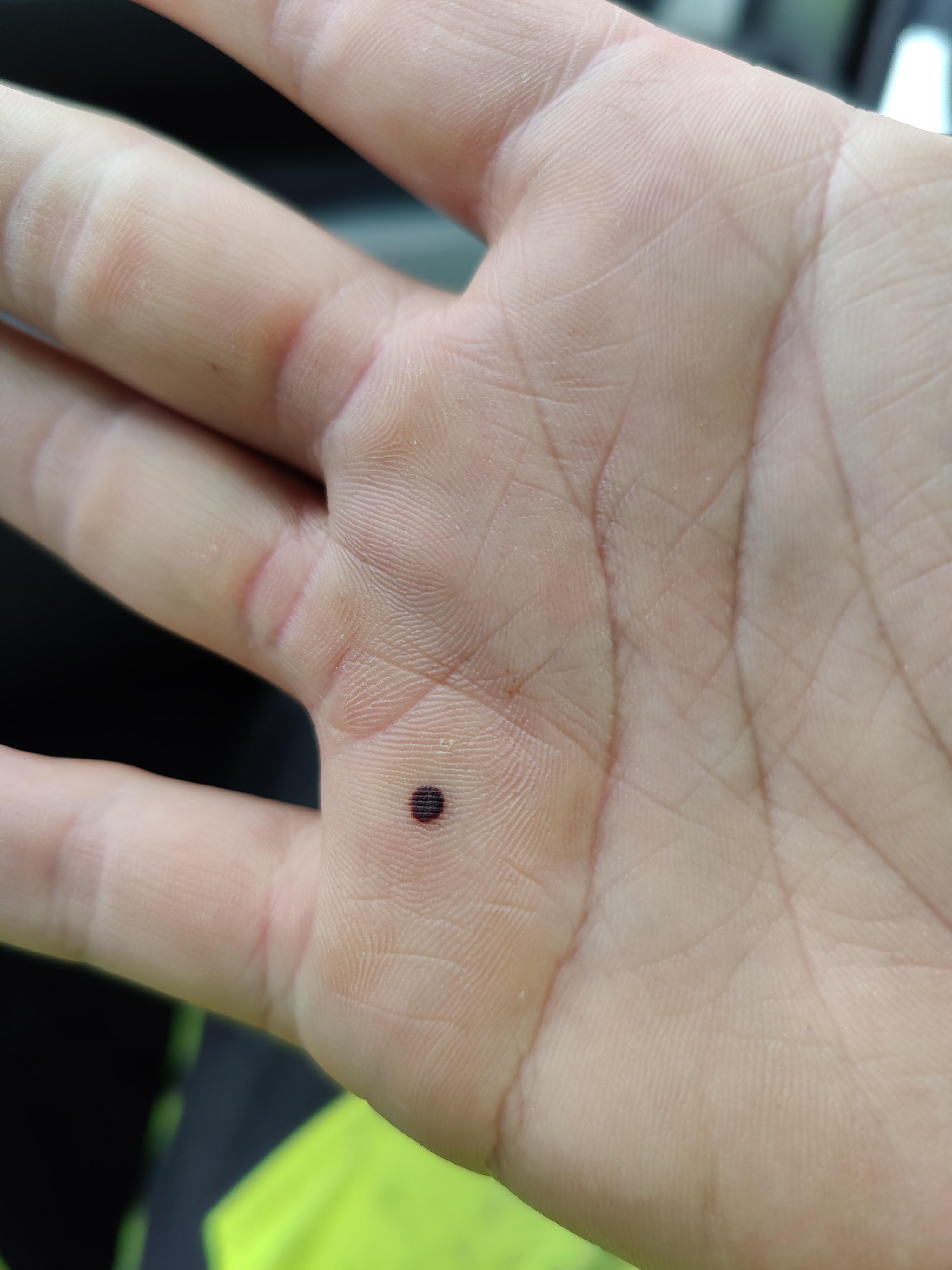 A few weeks ago I got a part of my palm stuck in a popup tent at work