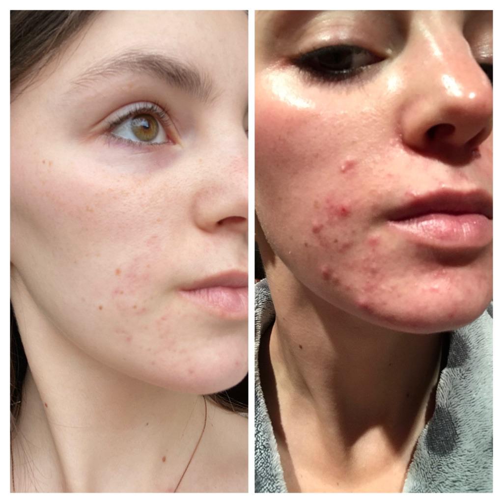 NOV 26 APR 15 BIG PROGRESS post oral & topical antibiotic treatment