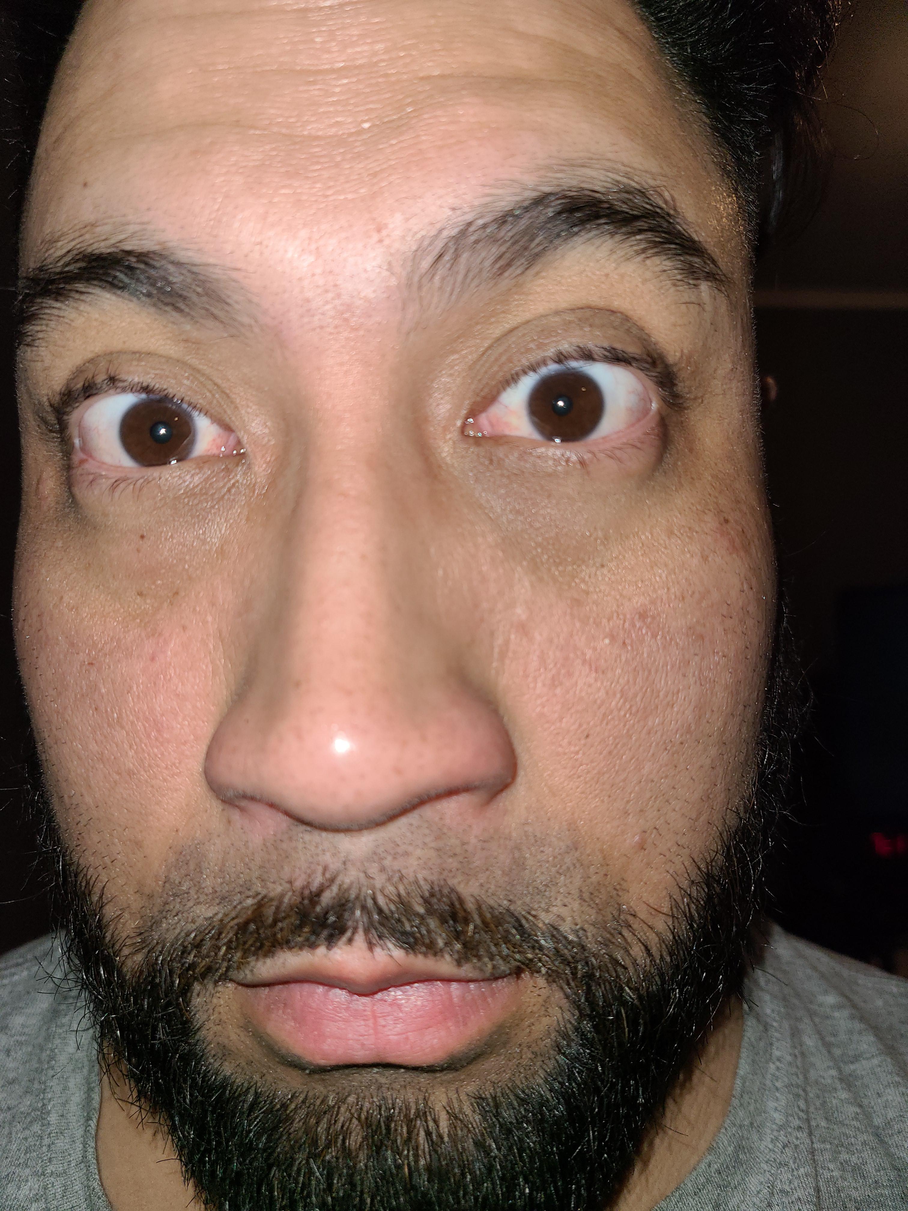 Jaundice or tired eyes? I always wake up with bloodshot eyes. But