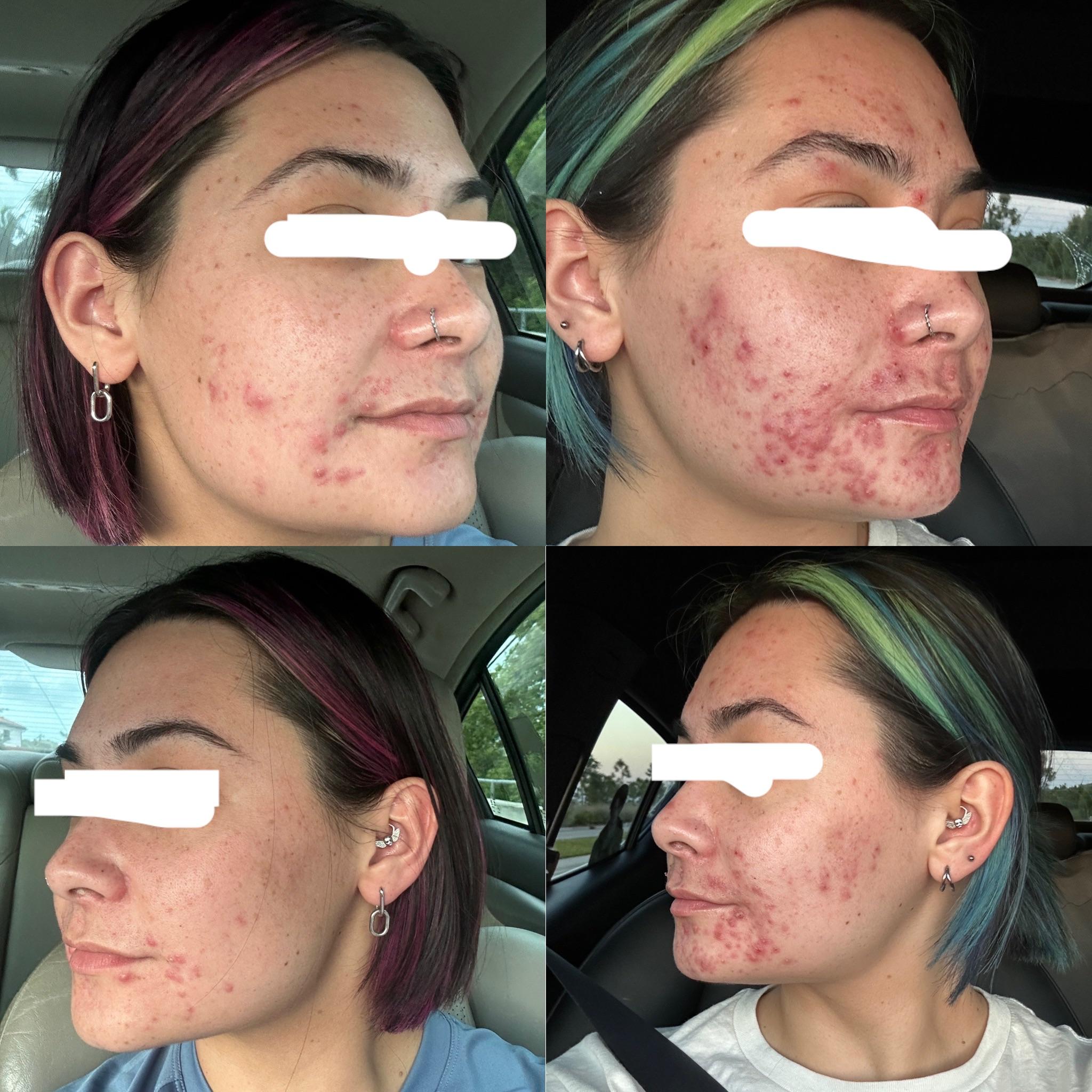 [Acne] 3 months on tretinoin and I feel like my skin has been ruined