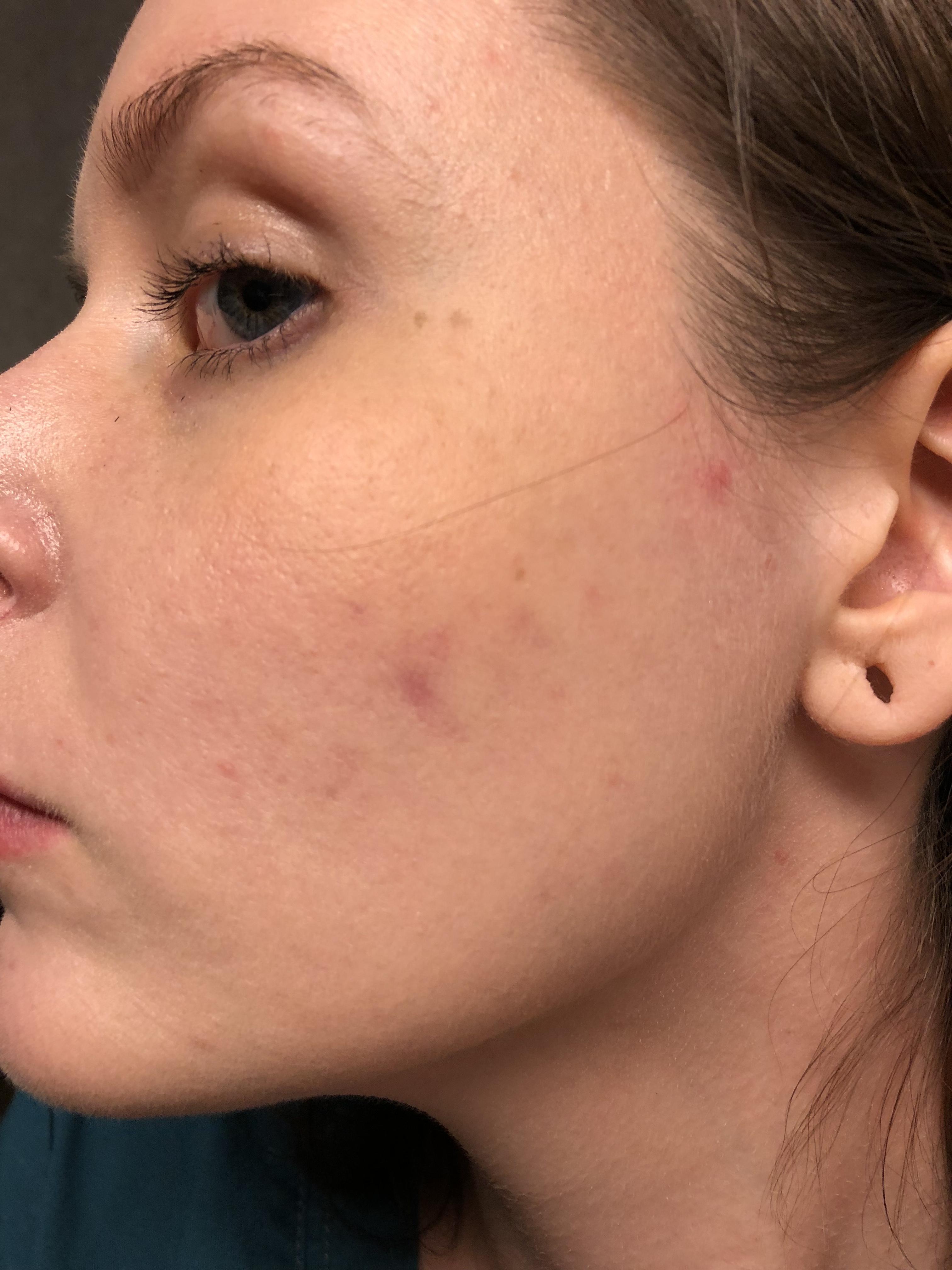 [acne] always breaking out right in my hair/sideburn area. Not sure why