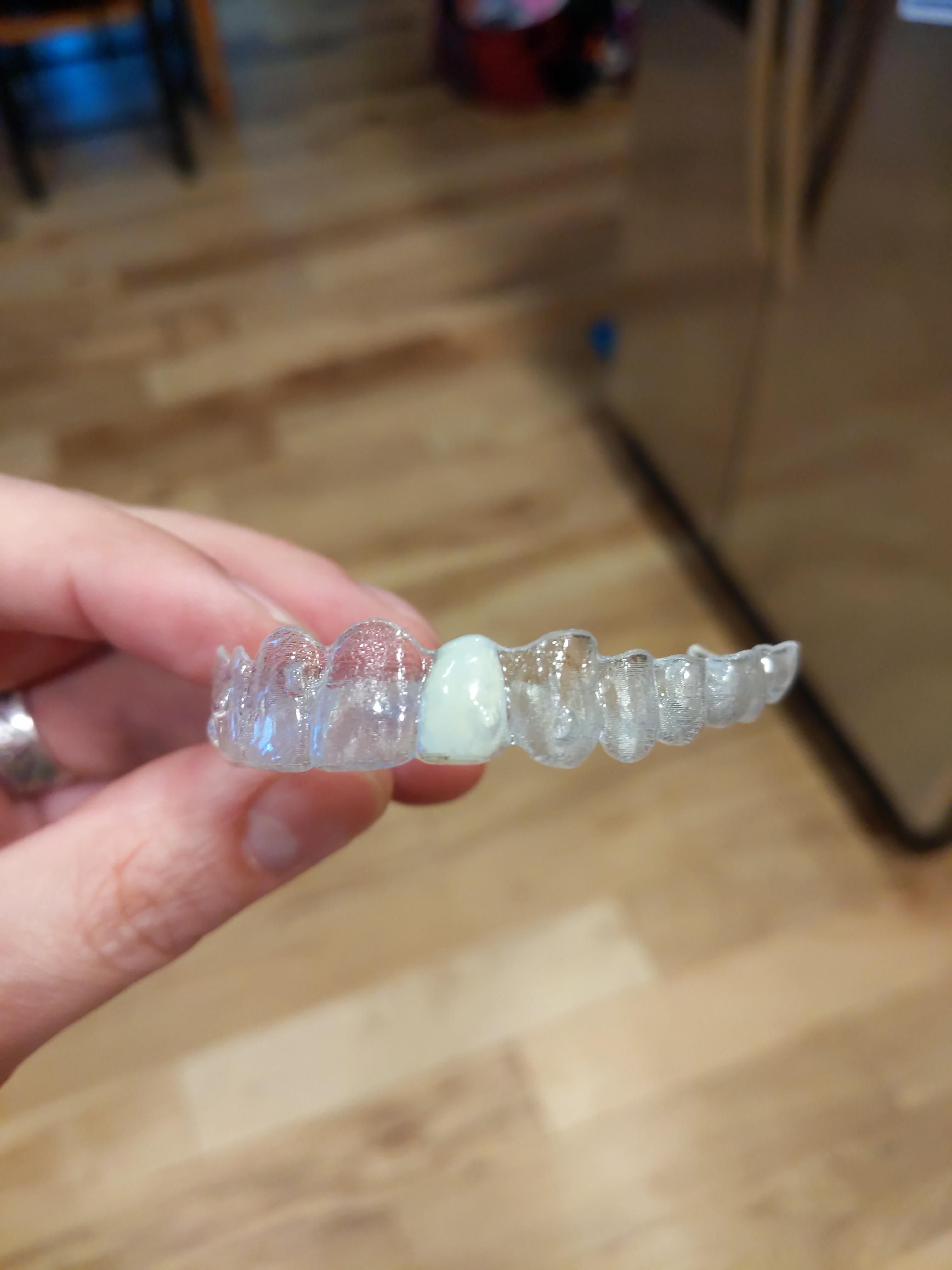 Can You Use Aligners With Missing Teeth Los Indios Texas