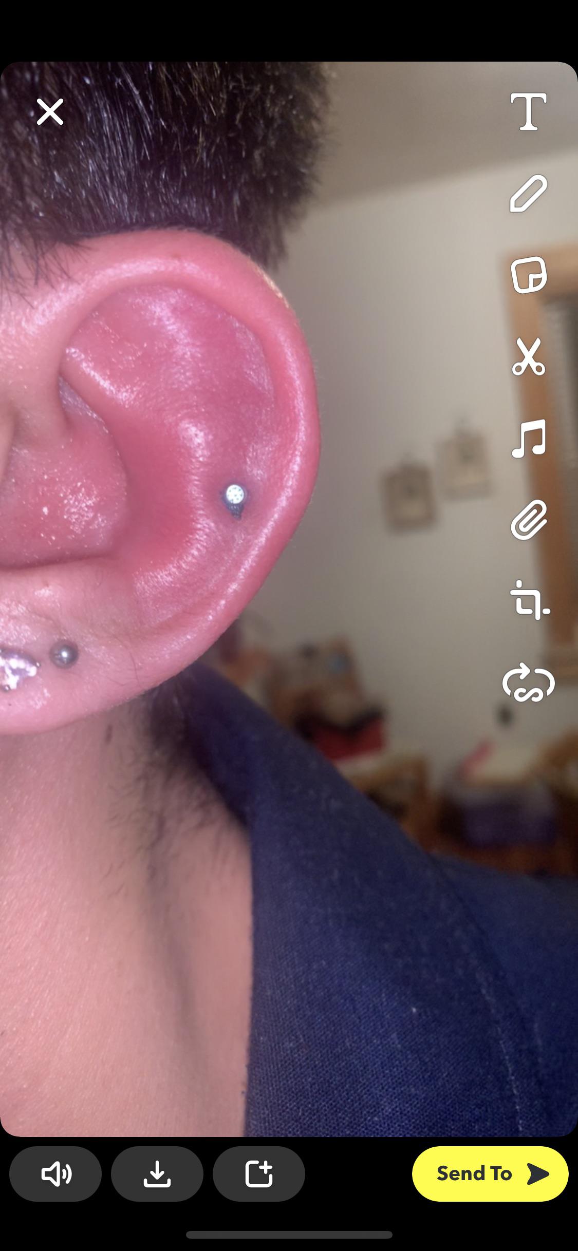 cauliflower ear, or swelling that will go back to normal? r/medical