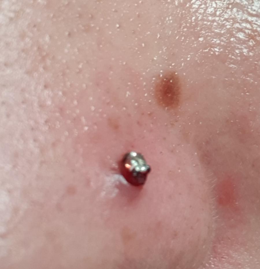 Nose piercing, infection gone but irritation bump? I am only using