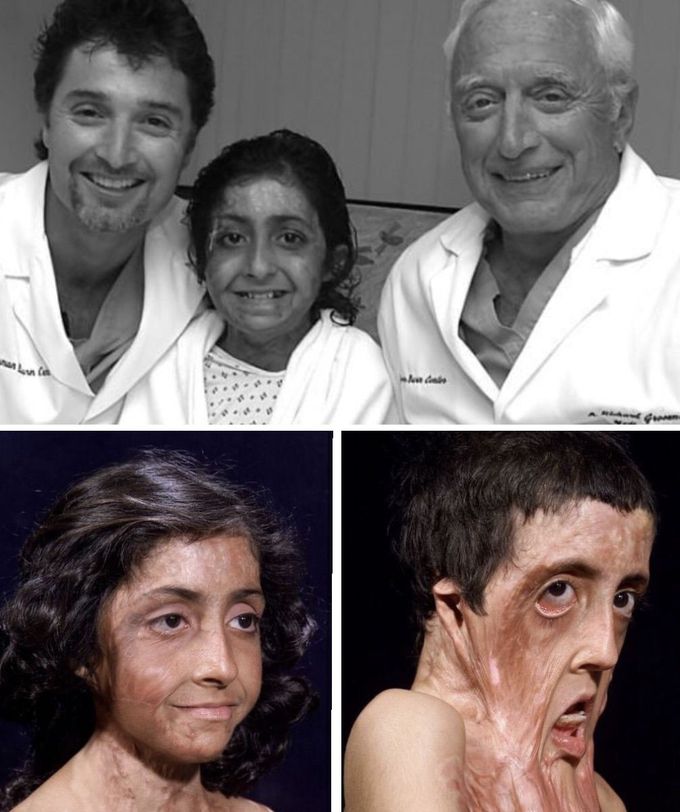 Burn Victim Gets Amazing Facial Reconstruction r/medizzy