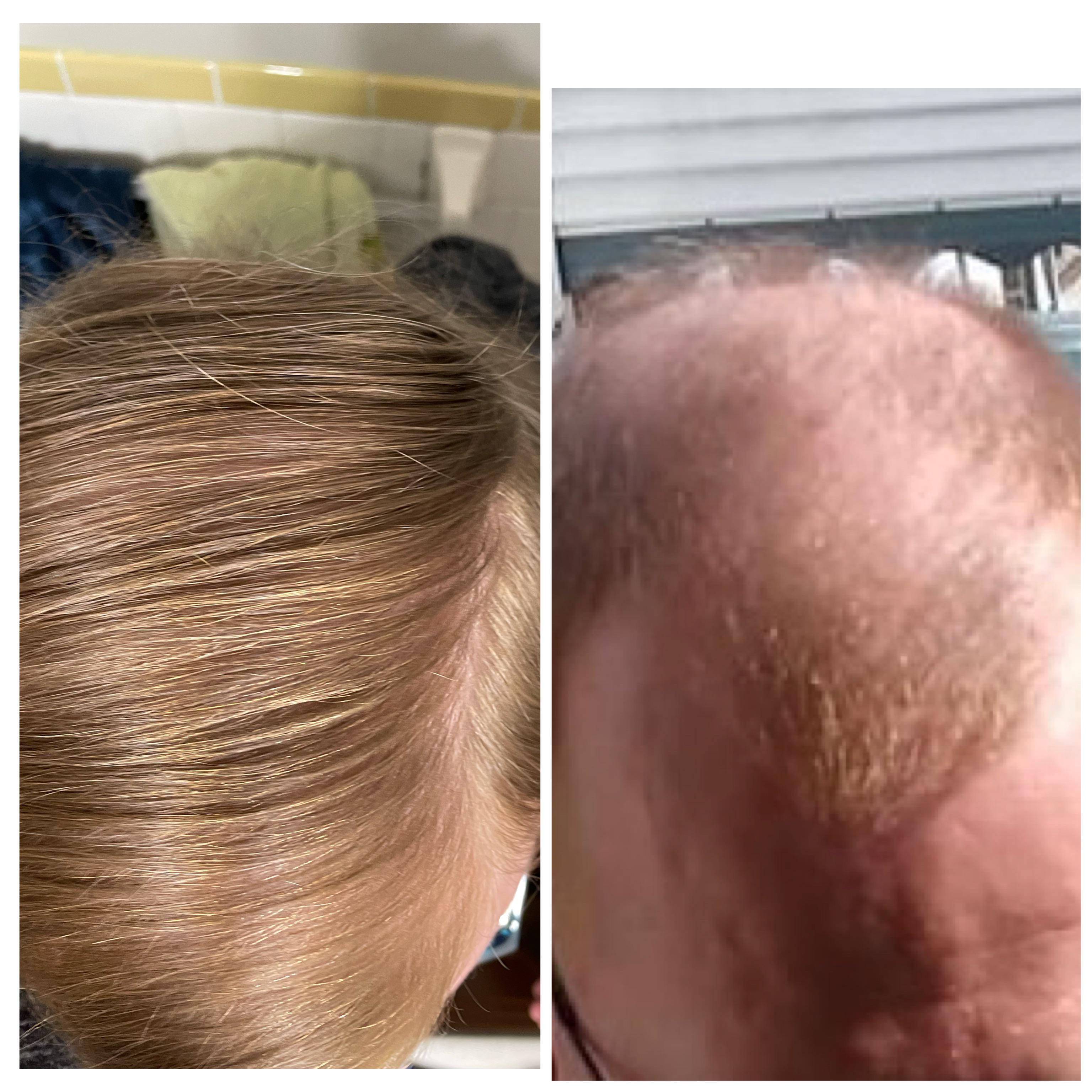 14 months HRT effect on hair at 39 y/o r/transtimelines