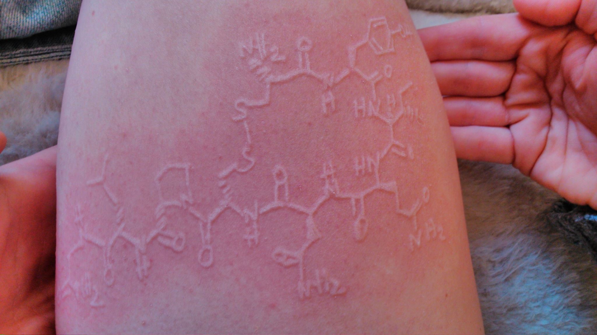 Dermatographia urticaria is a dermatological medical
