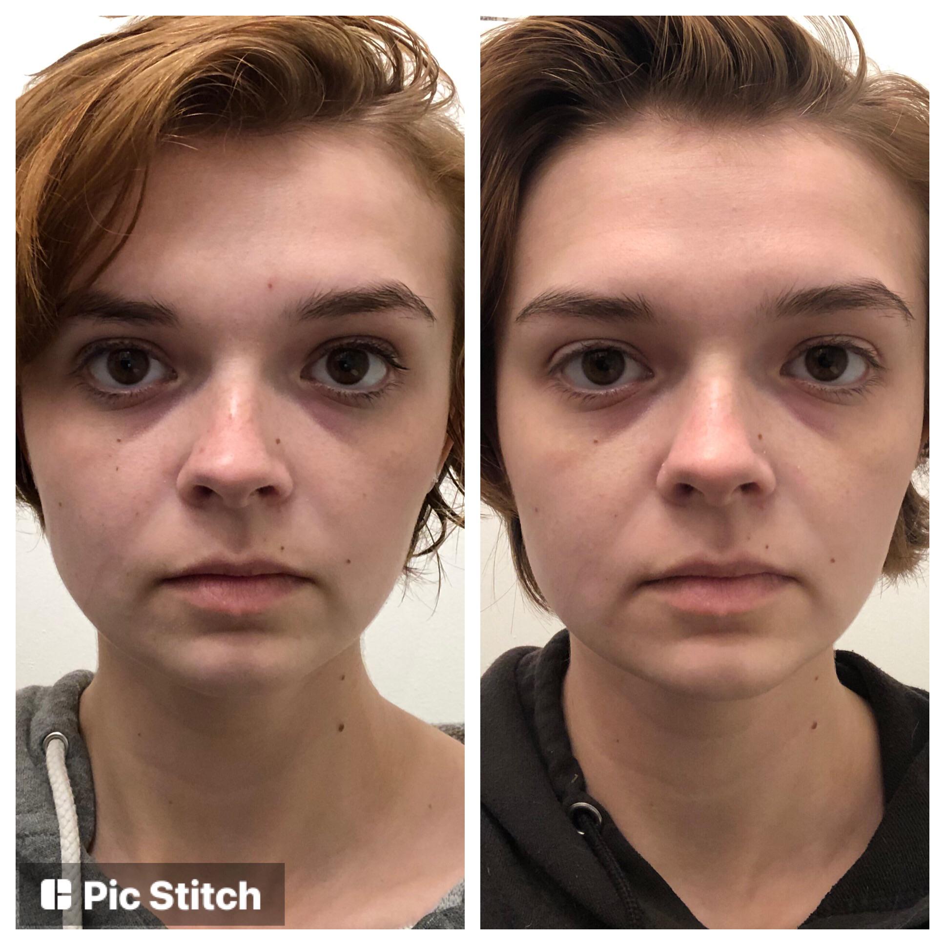 more cyclical face comparisons! left is ovulation day, right is