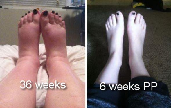 Milenium Home Tips When Do Feet Swell During Pregnancy