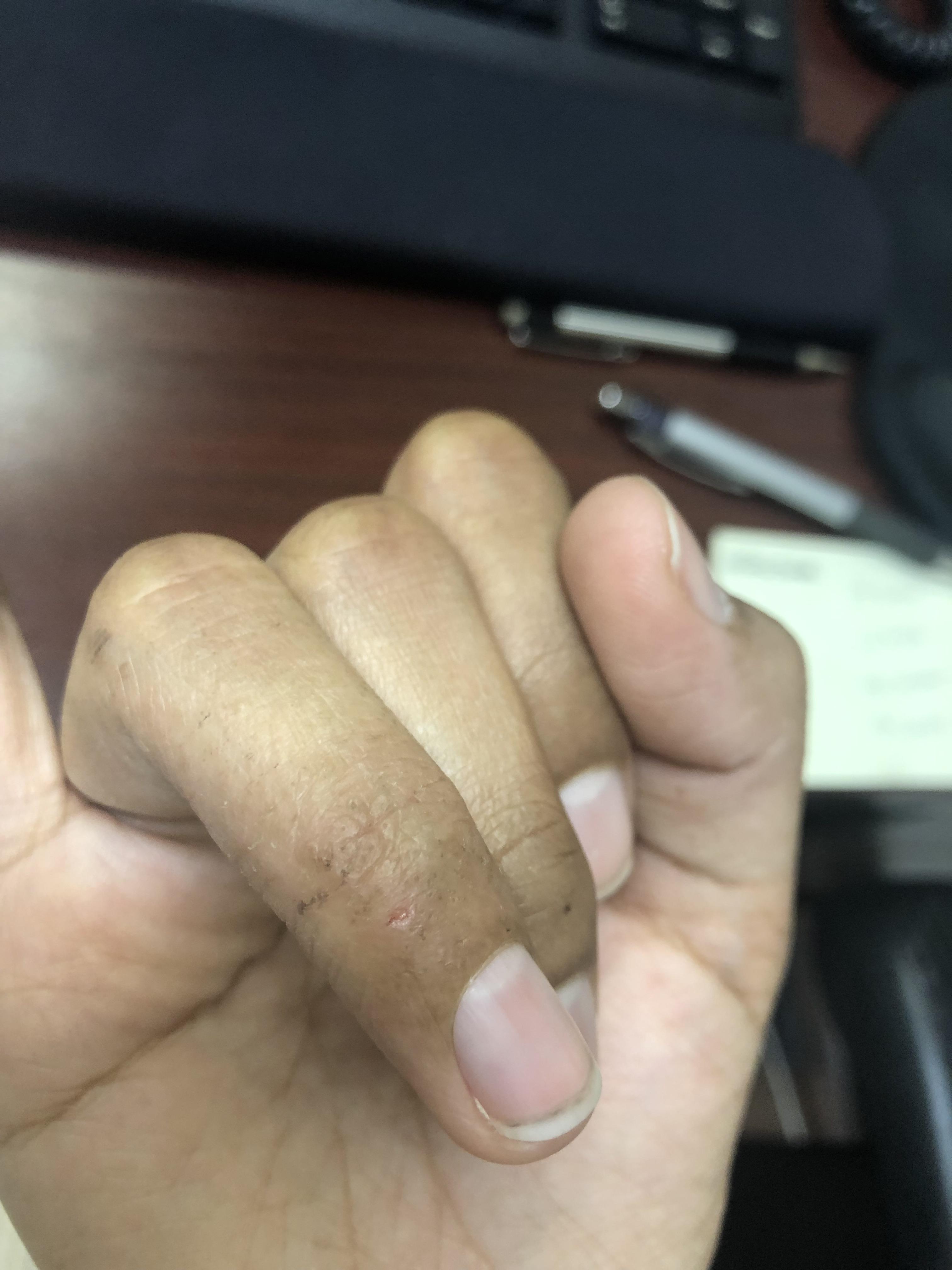 My ring finger and thumb often going into cycle of getting small bumps