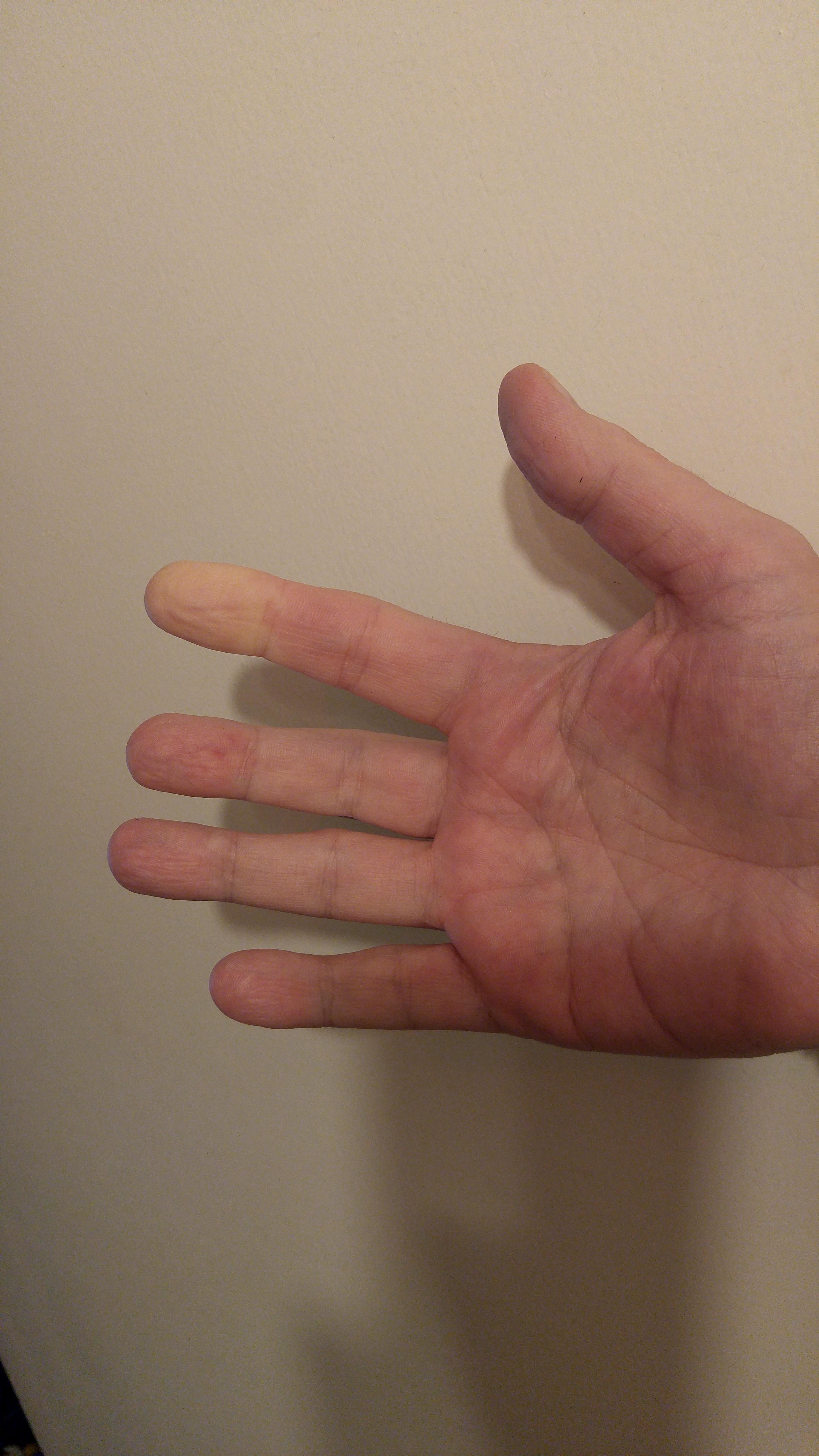 Raynaud's Phenomenon. Even right out of a hot bath it suddenly does
