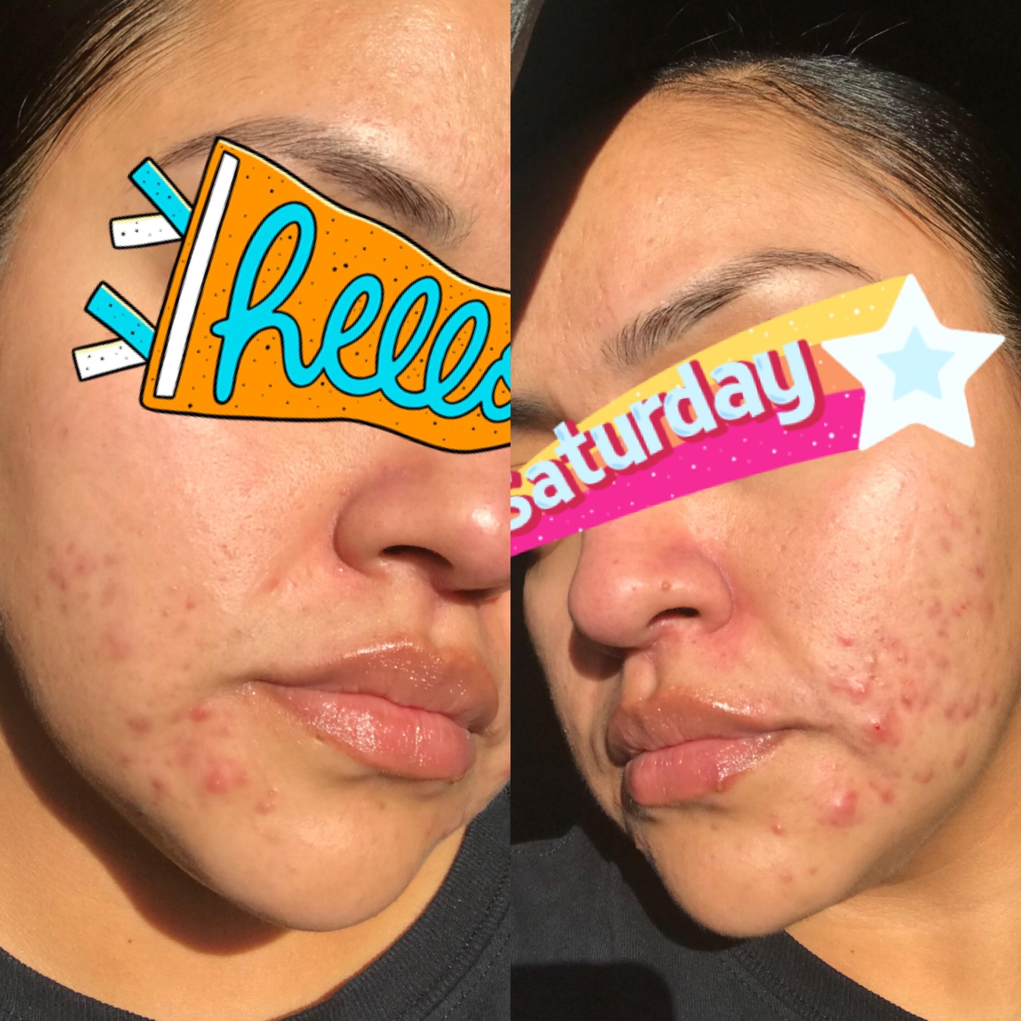 [Acne] Can anybody help? Proactiv left my face worse than what I