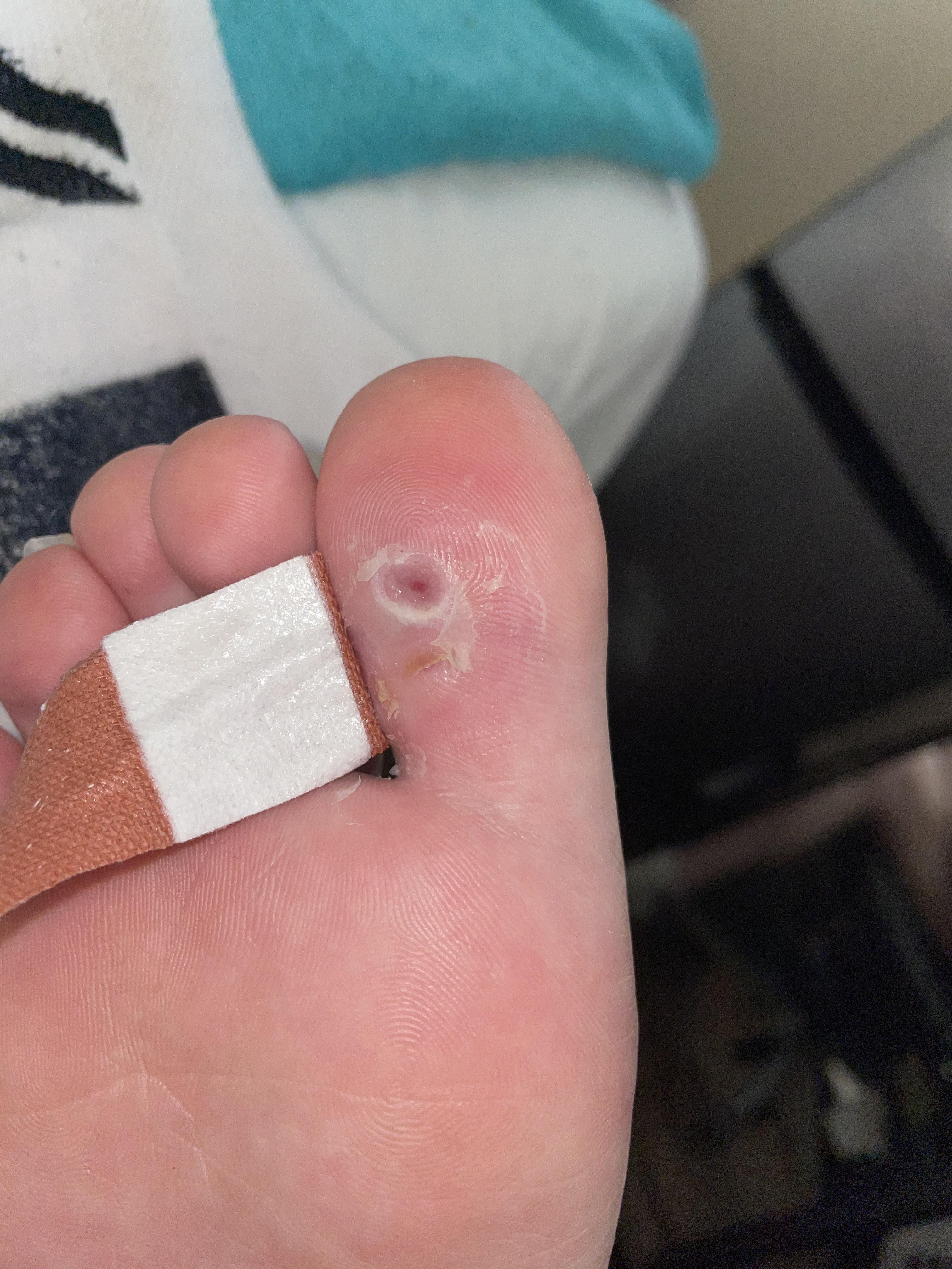 just got a heated foot tub and started hot water treatments and pretty