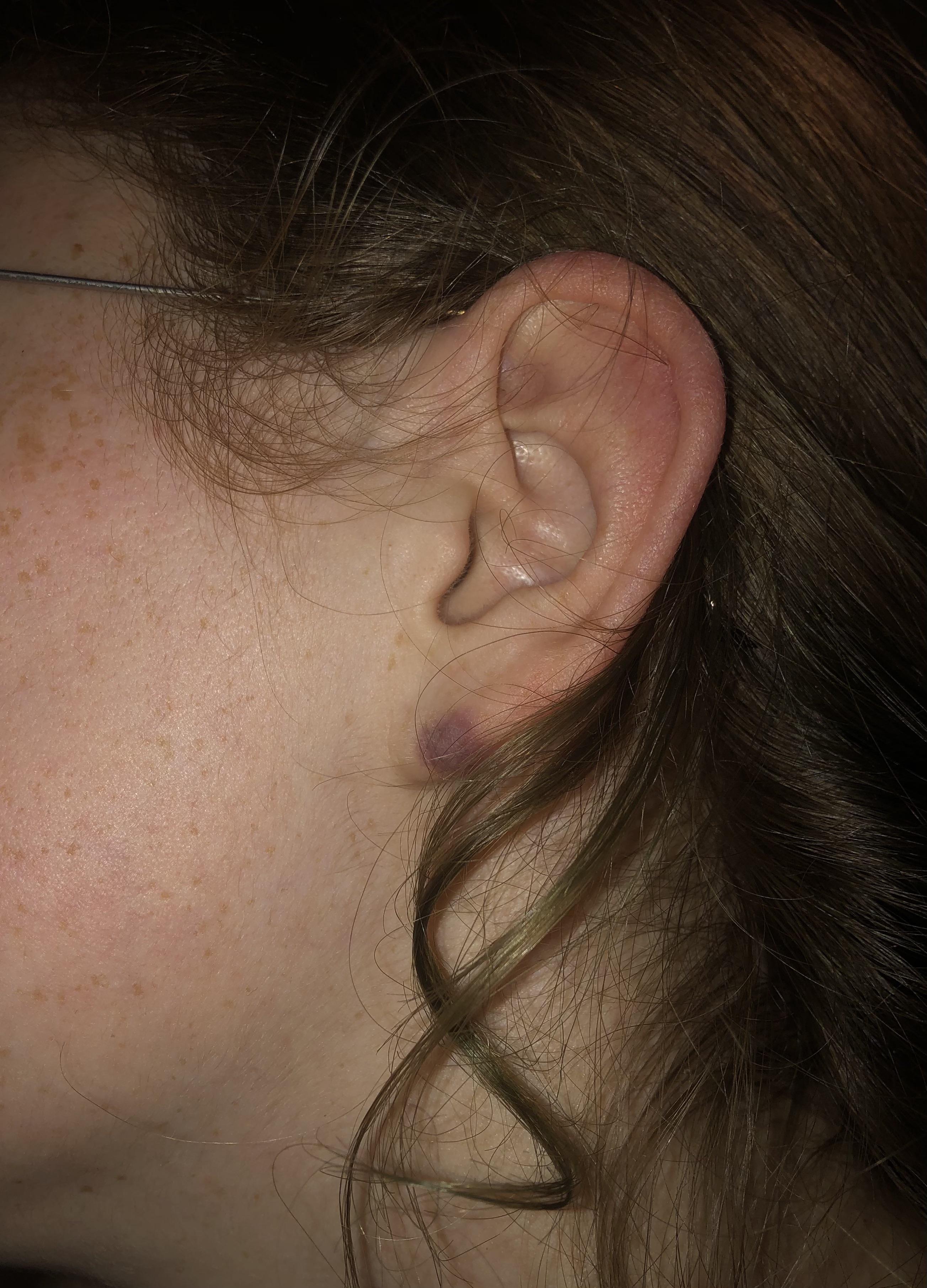 What is this bruise like thing on my girlfriend’s left ear lobe? popping