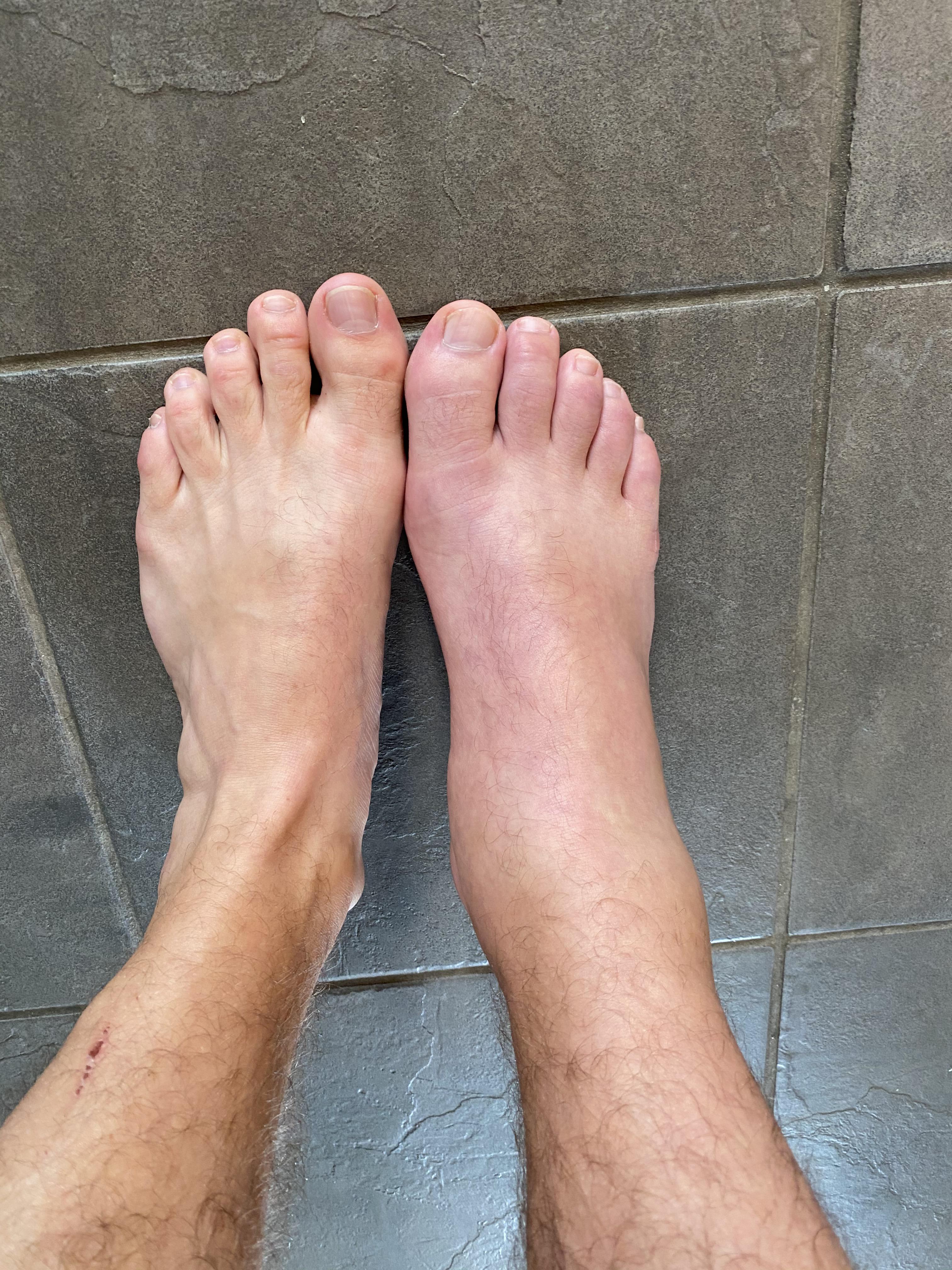 Severe or average? This is 24 hours after my 4th attack. It was just as