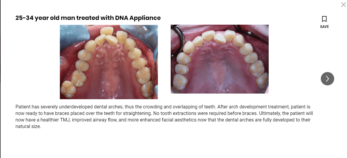 Nonsurgical expansion of the Palate achieved with the DNA appliance in