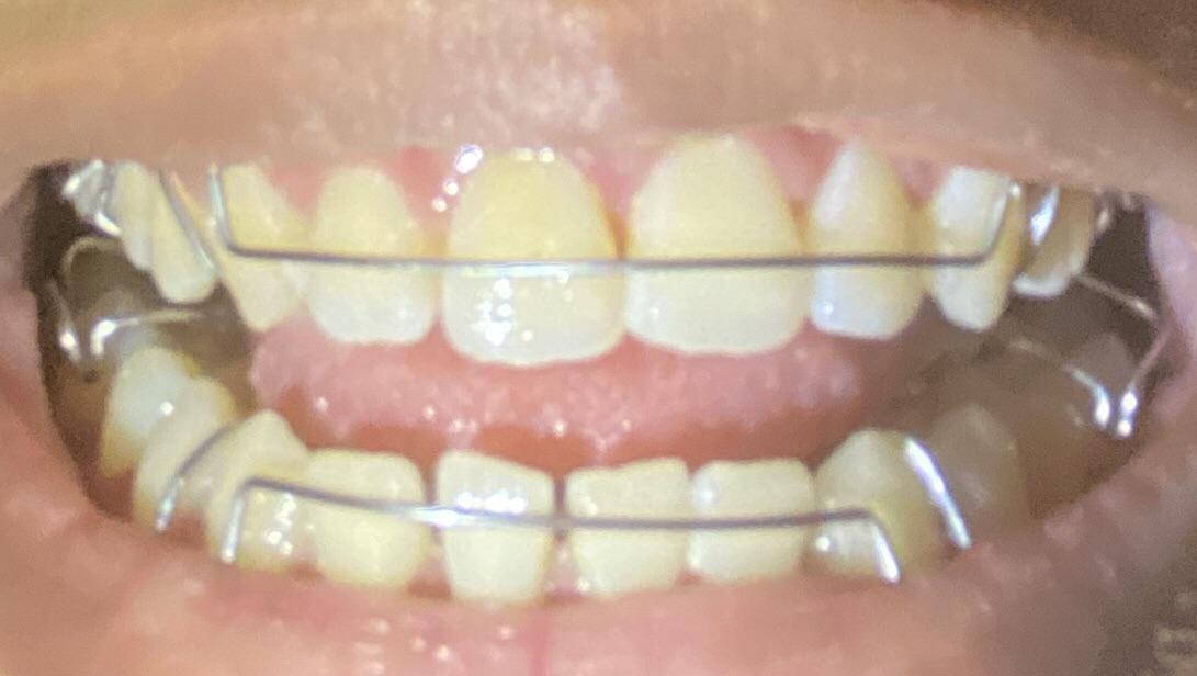 Teeth move after not wearing retainer regularly. Should I order new