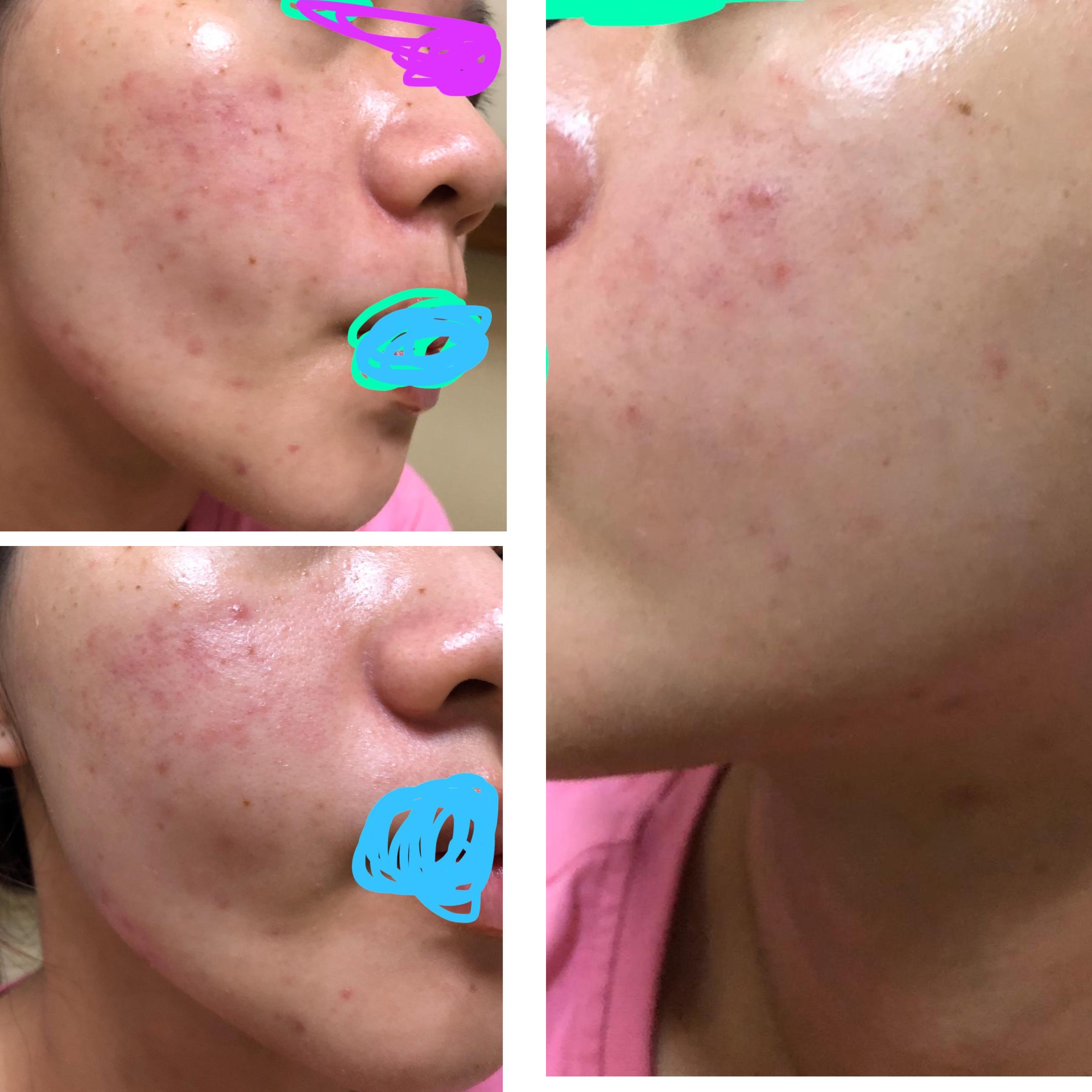 Kojic Acid Before And After