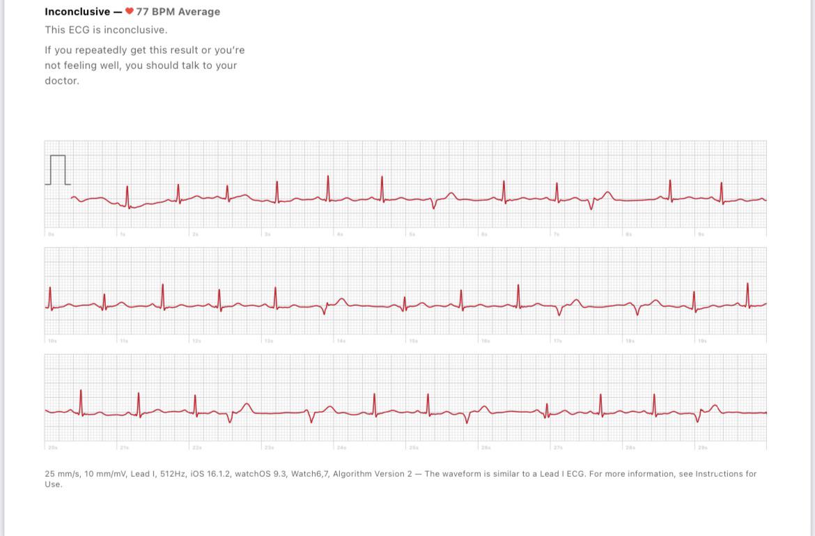 Are these just PVCs? Feel like palpitations, I’m on beta blockers for q