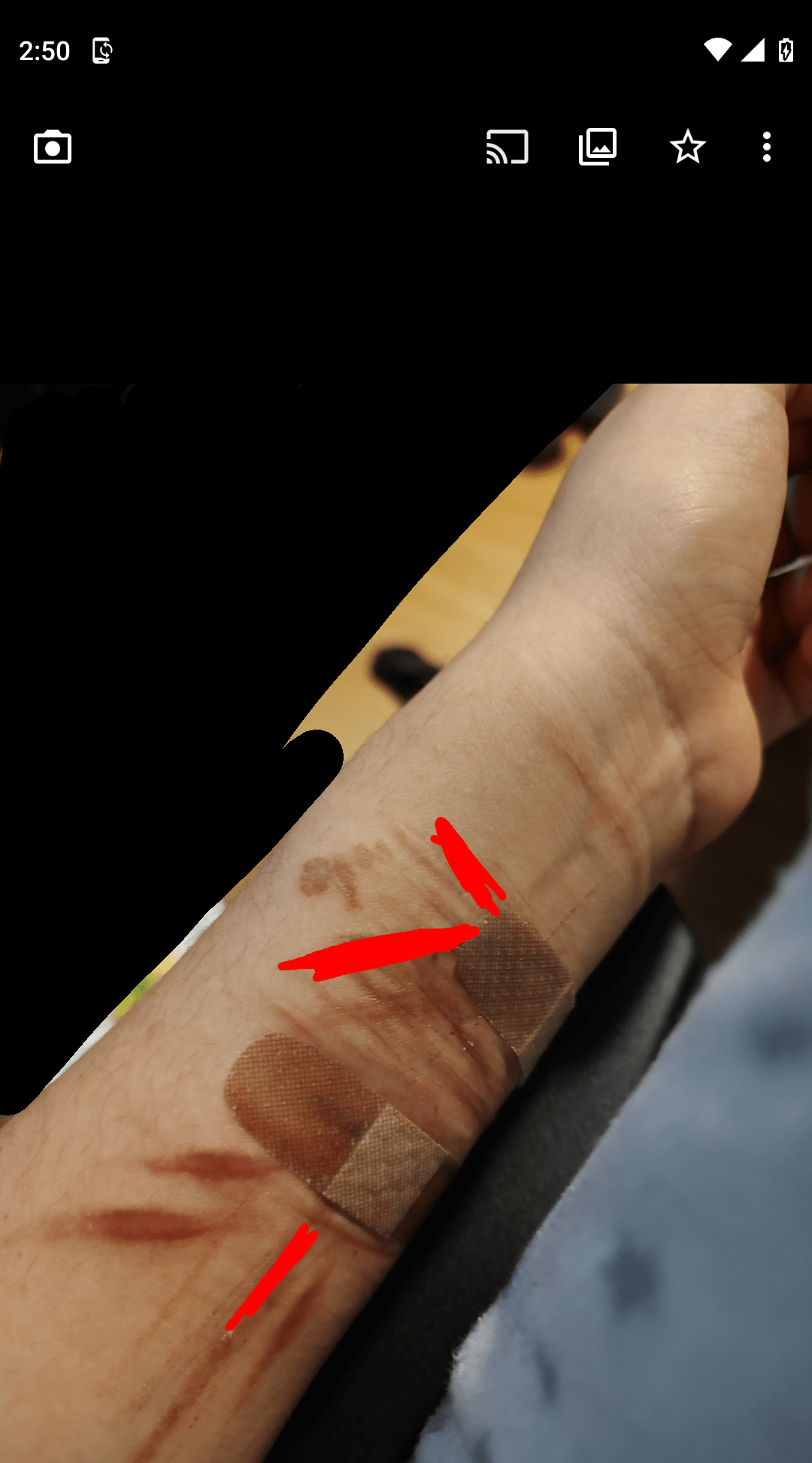 How long do burn scars take to fade? r/SelfHarmScars