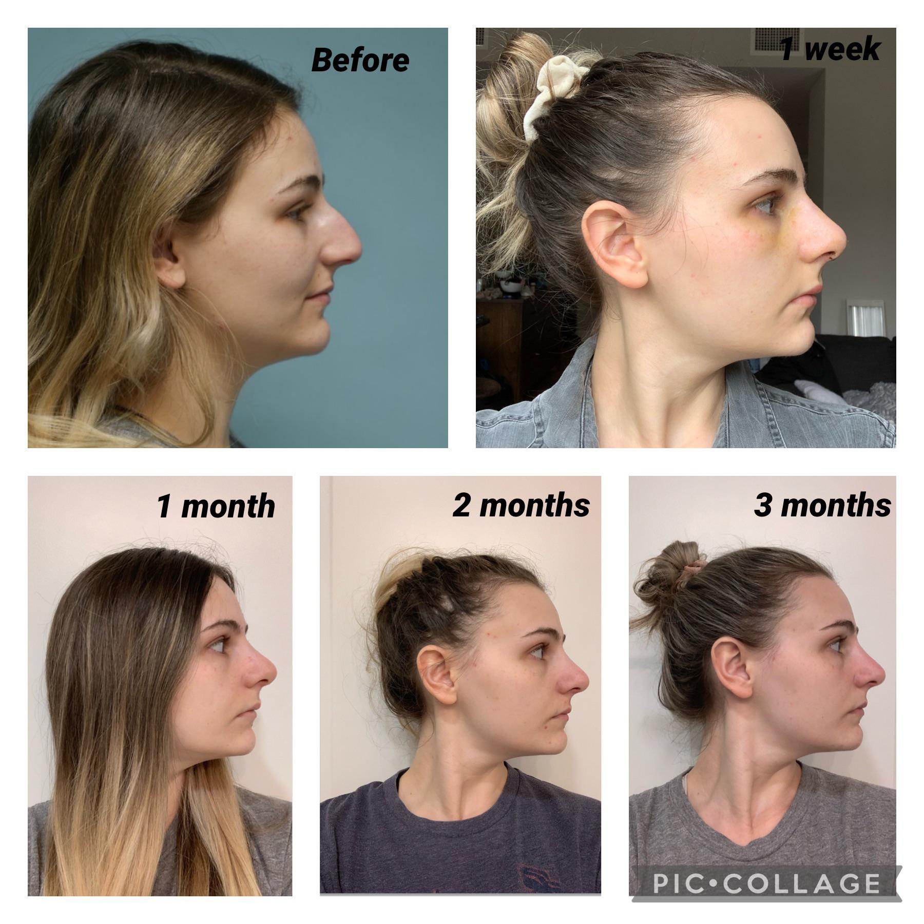 3 months after septorhinoplasty and wanted to share my healing progress