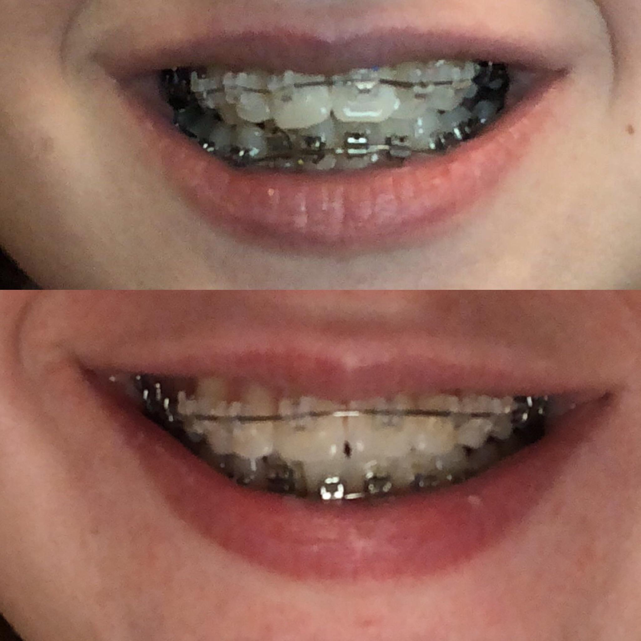 Adult braces at 20 years old, about 3 months in! Problems are severe