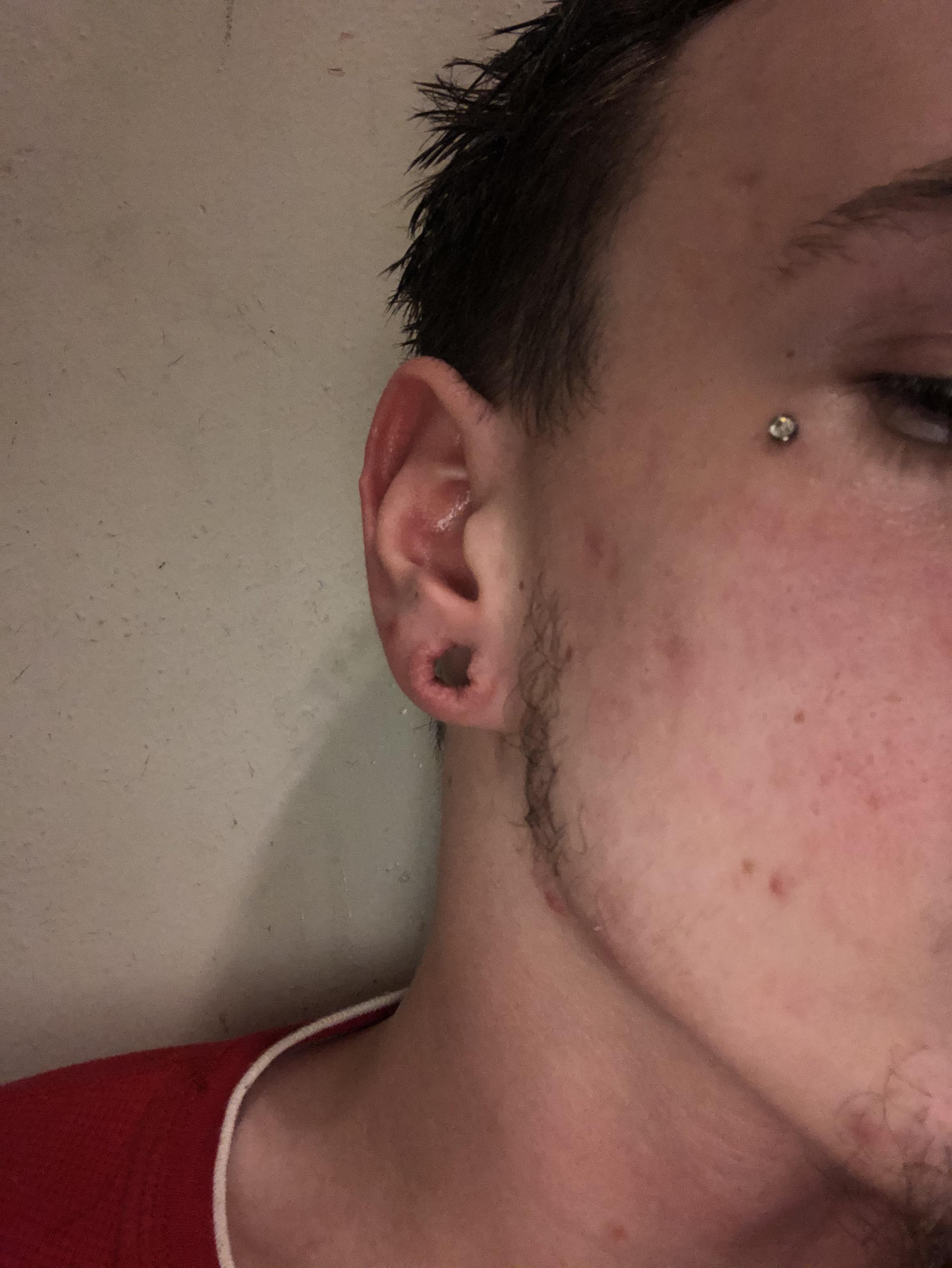 How to make scar tissue in stretched lobes go away, besides massaging