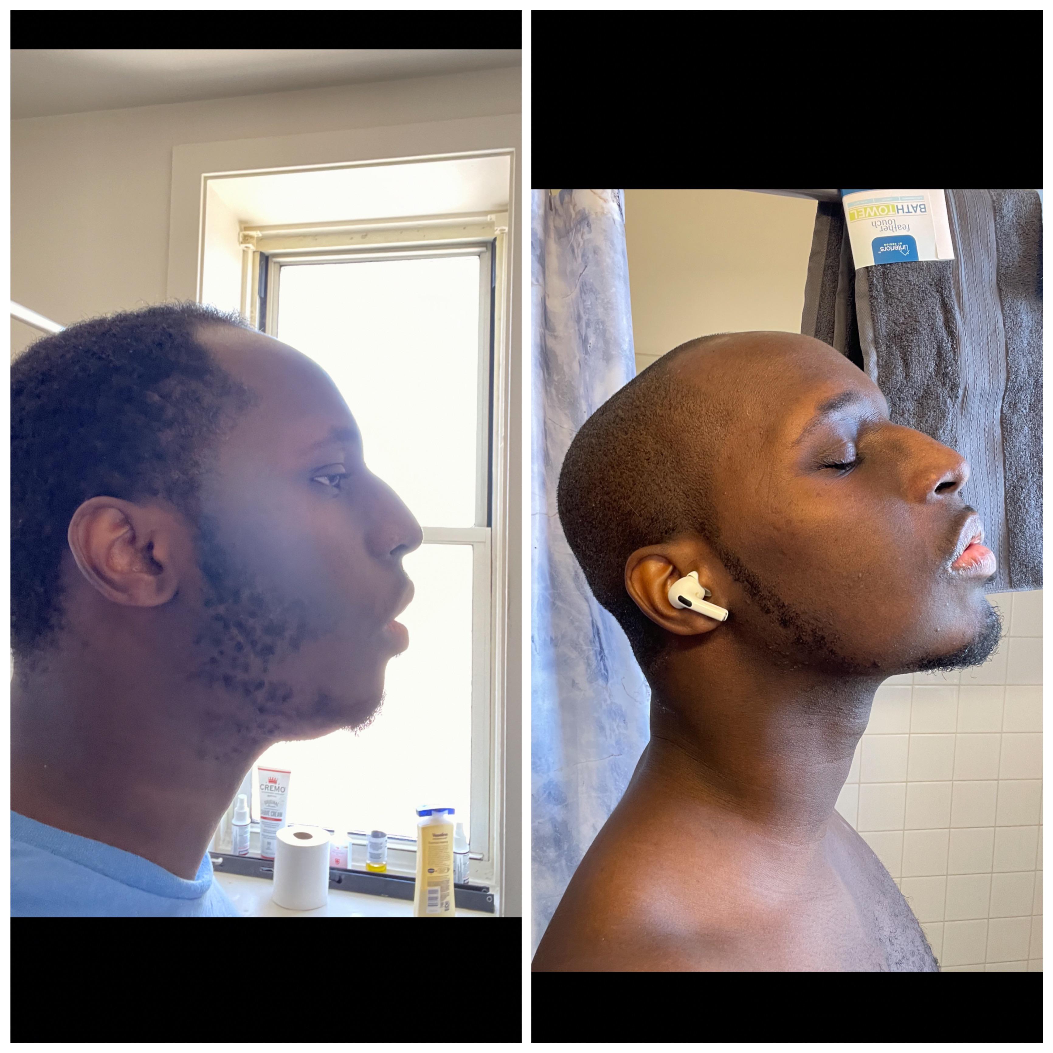 Jawline Surgery Men Before And After