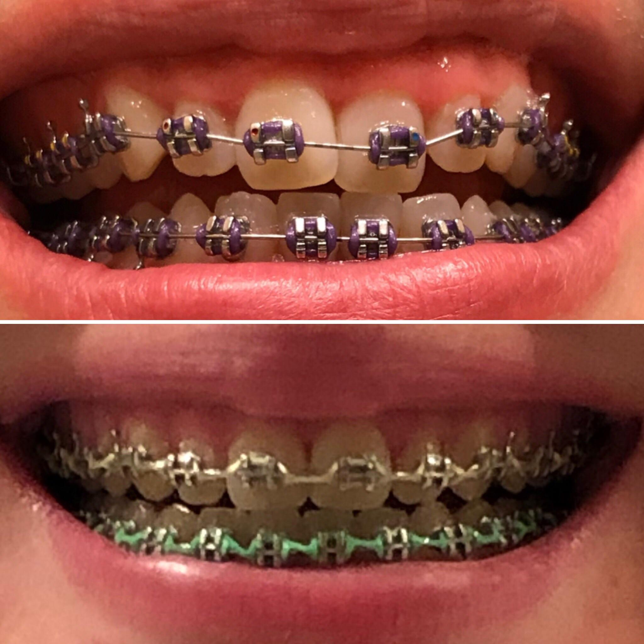 13 month progress. Ortho projected 24 months and keeps saying , “ You