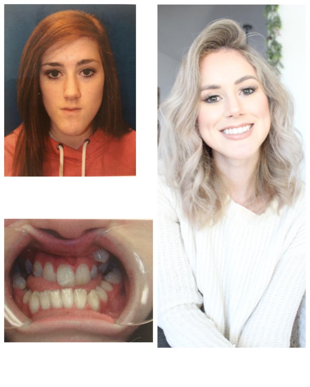 November 2010 vs March 2020 4 years of braces, double jaw surgery and