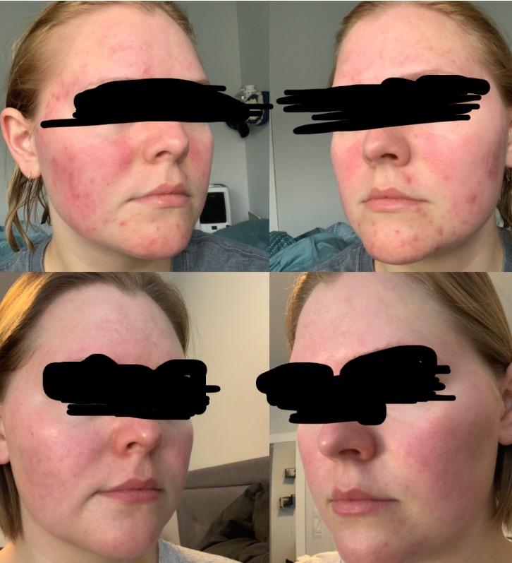 [Before&After] 11 month skin progress r/SkincareAddiction