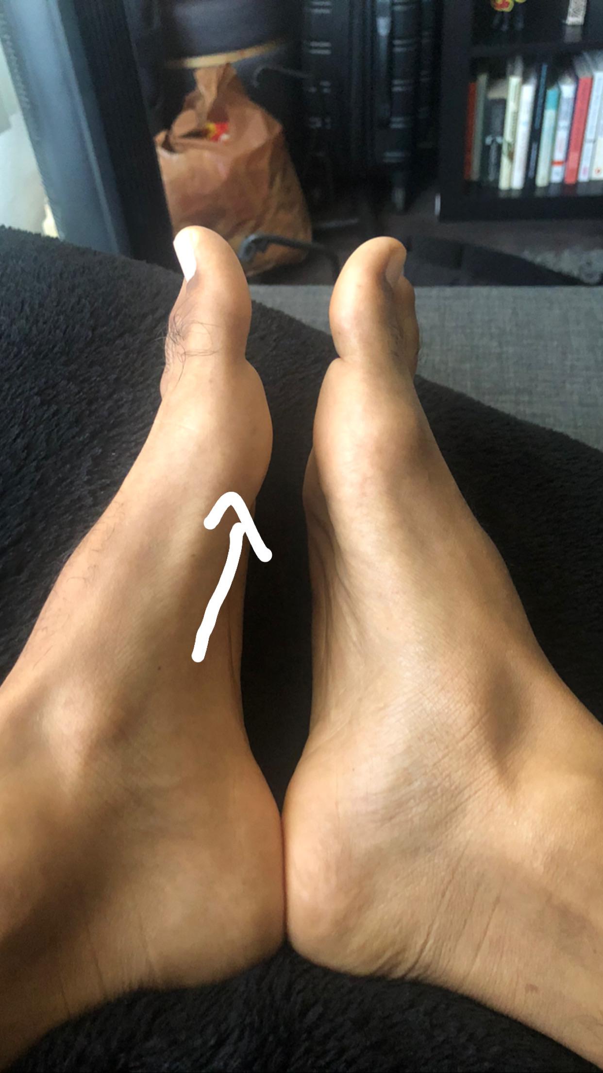 Hyperextended by big toe upwards and now the joint under it is tender