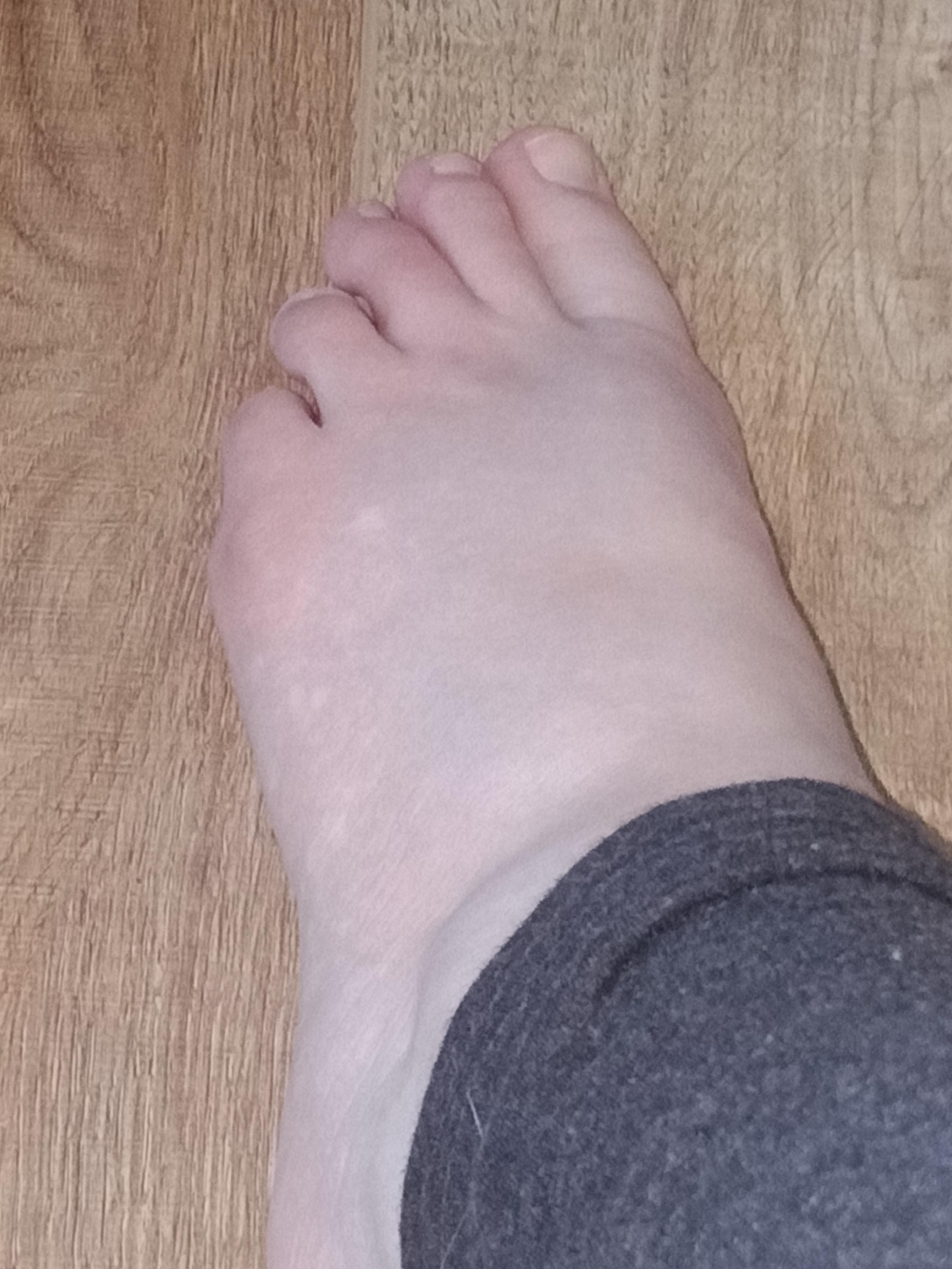 Does Anyone Get White Spots And Redness On Their Feet After They Walk?? : R/Ehlersdanlos