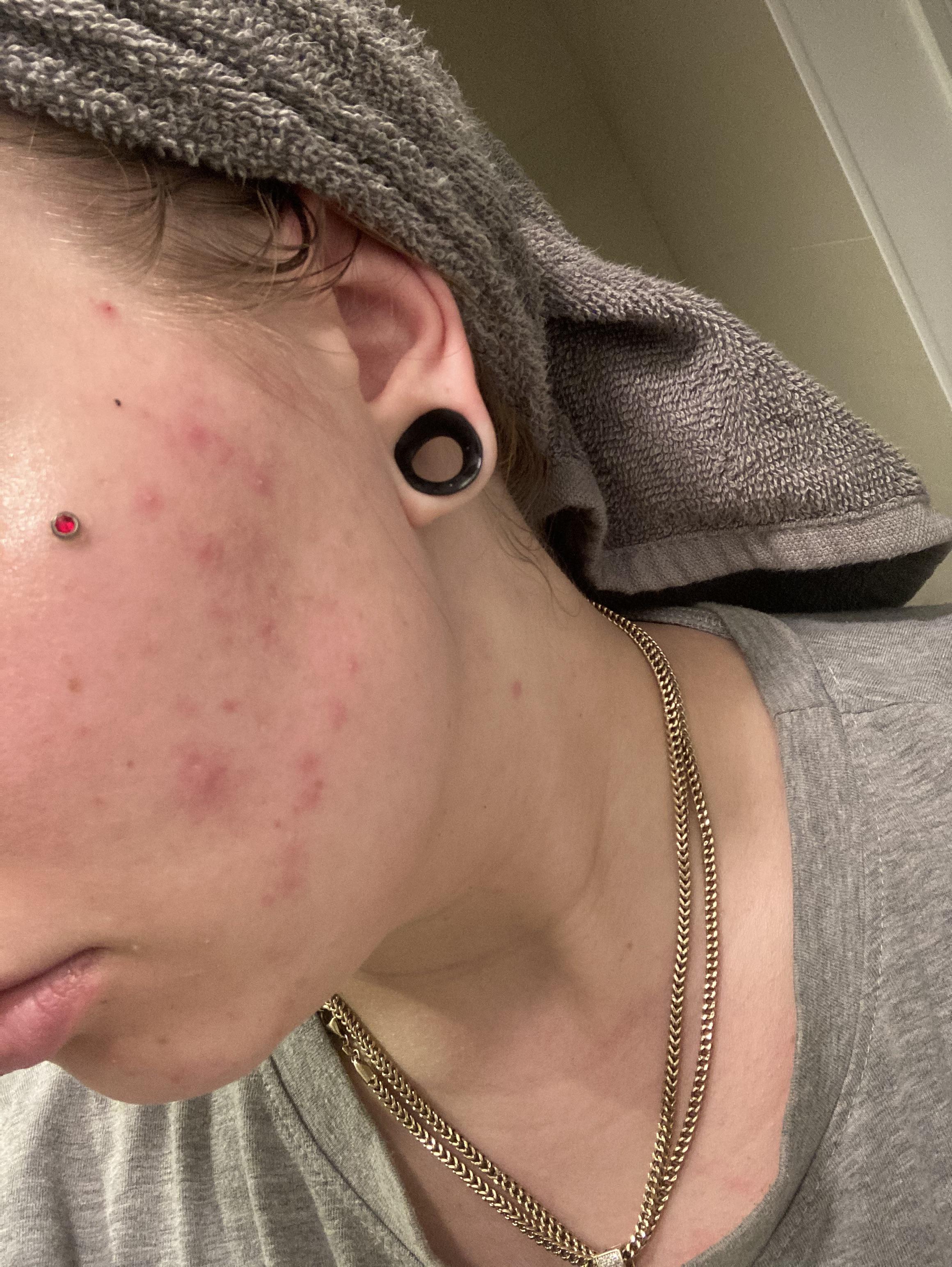 Why am I breaking out like this at 27? Both sides! I change my pillow