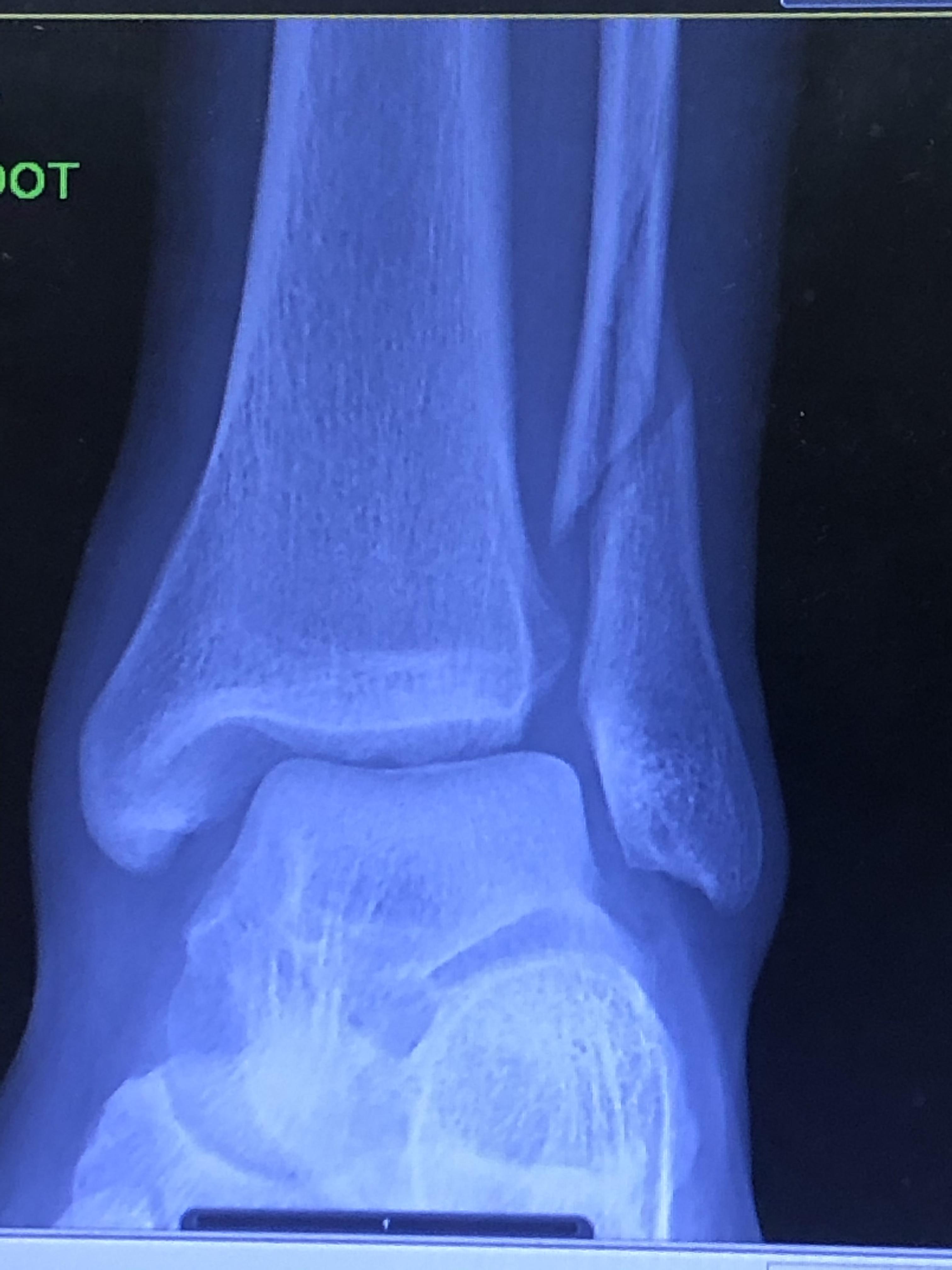 First broken bone whilst playing football, there isn’t a single