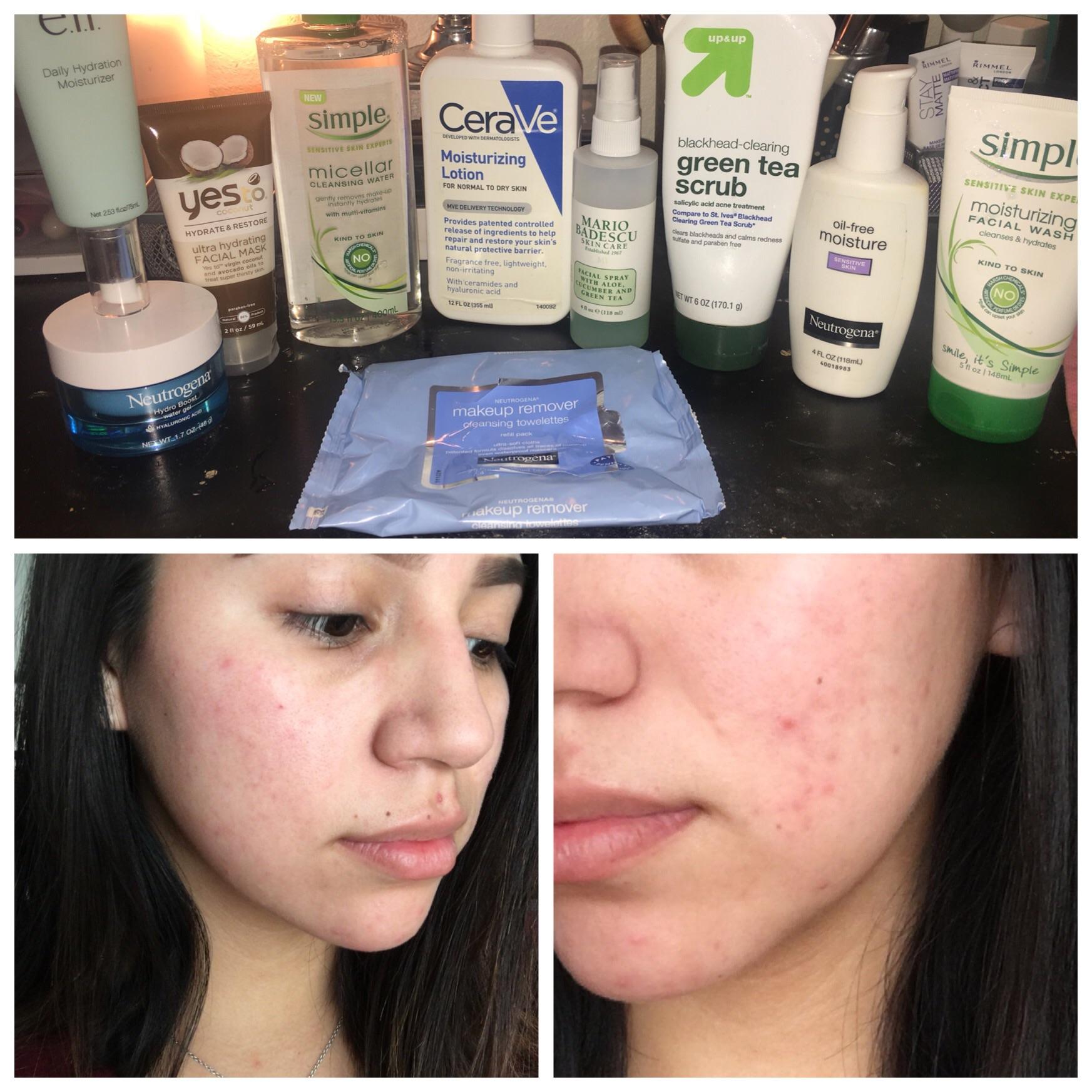 Help!! My face is red & I thought I had only dry skin so I switch my