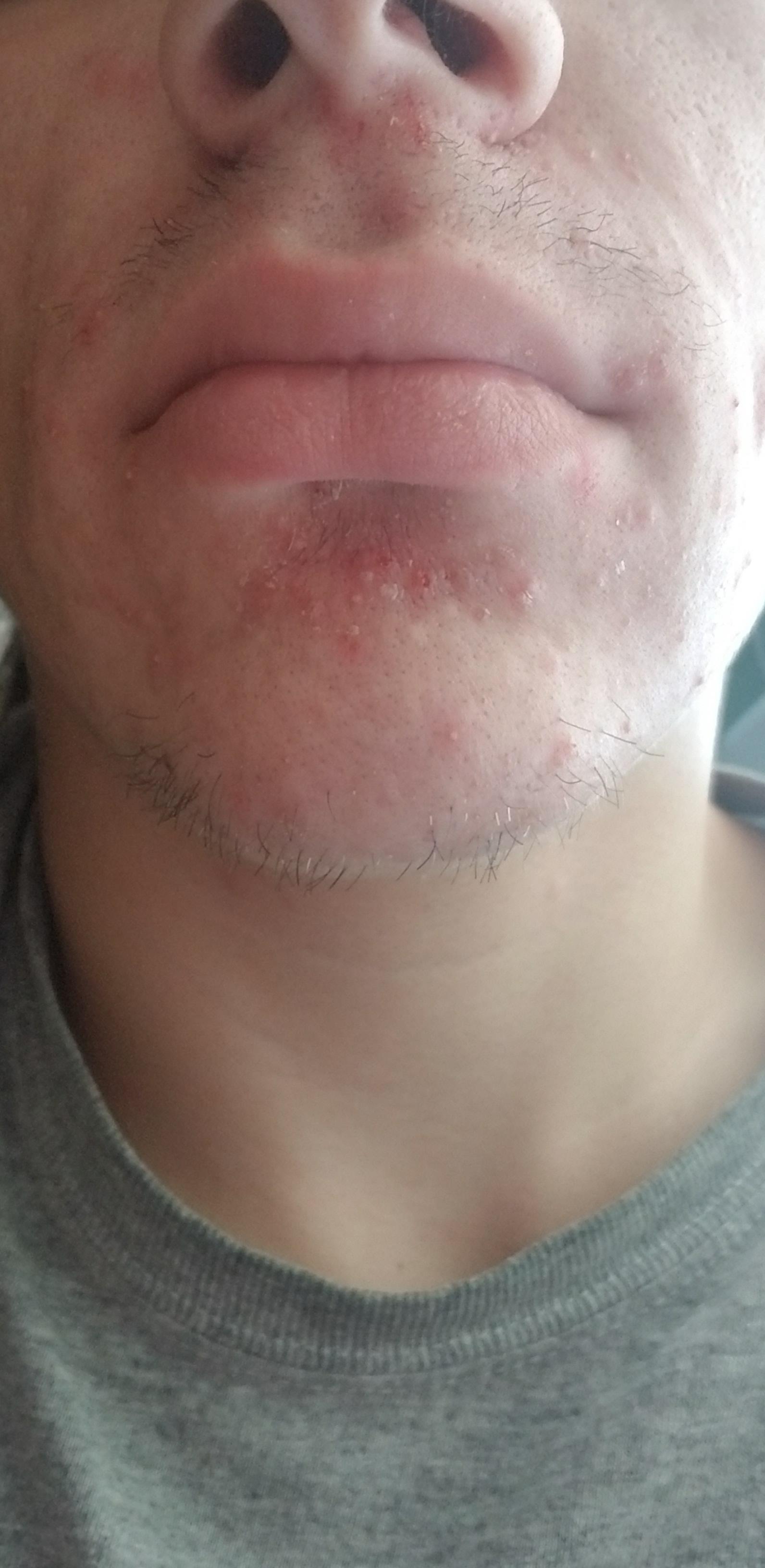 My acne has been terrible around my nose and mouth. Any possible solutions or treatment? r/acne
