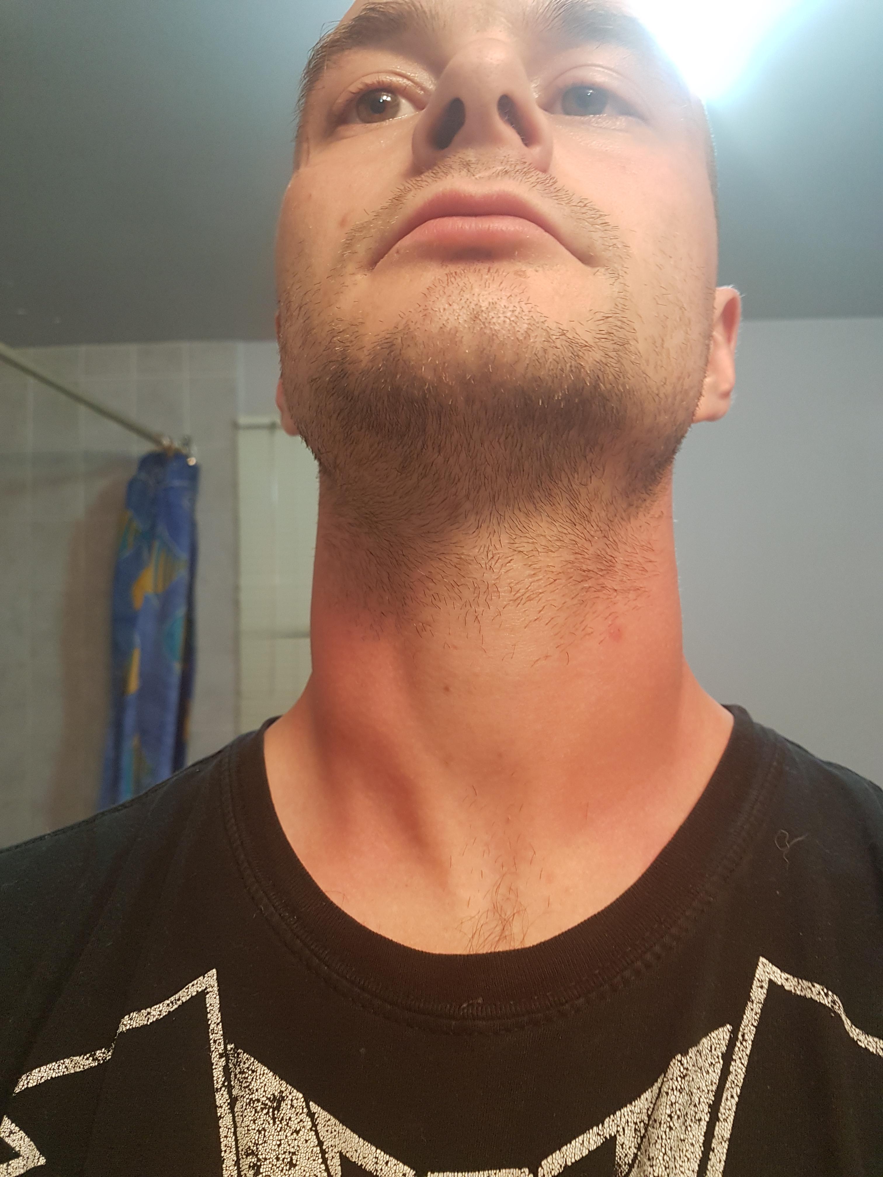 What Is Biting Me At Night In My Bed It Swells And Itches